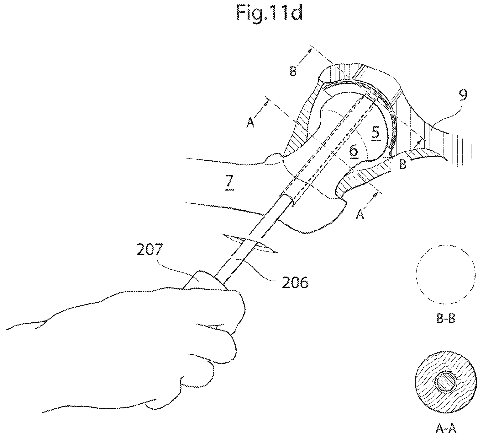 Patent US12137920 Figure 8 – Medical device and method for treatment of hip joint