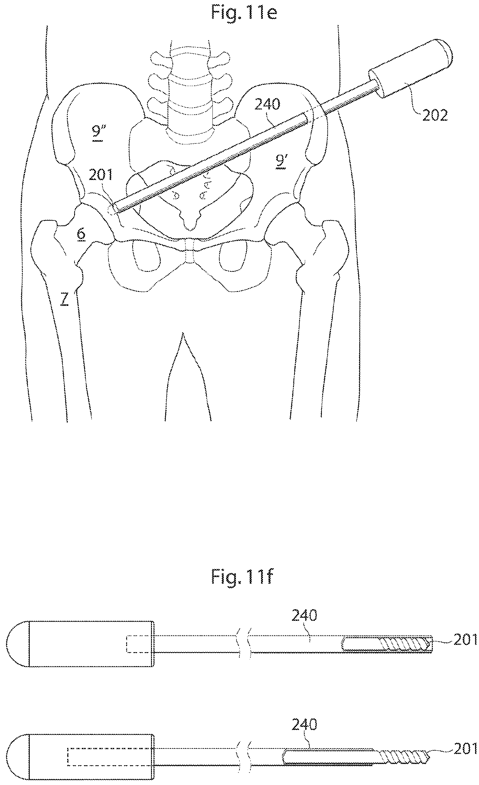 Patent US12137920 Figure 9 – Medical device and method for treatment of hip joint