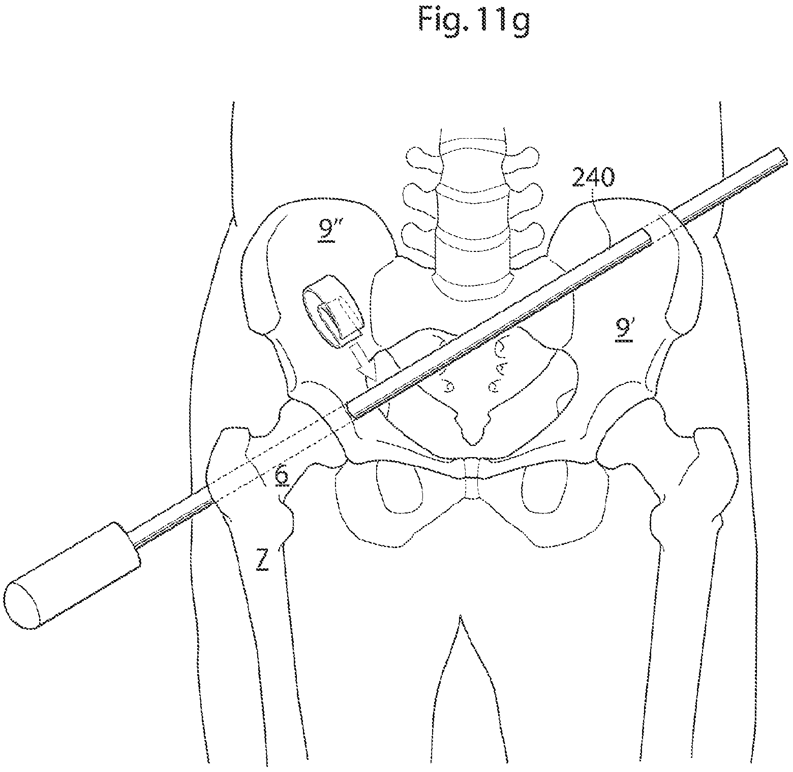 Patent US12137920 Figure 10 – Medical device and method for treatment of hip joint