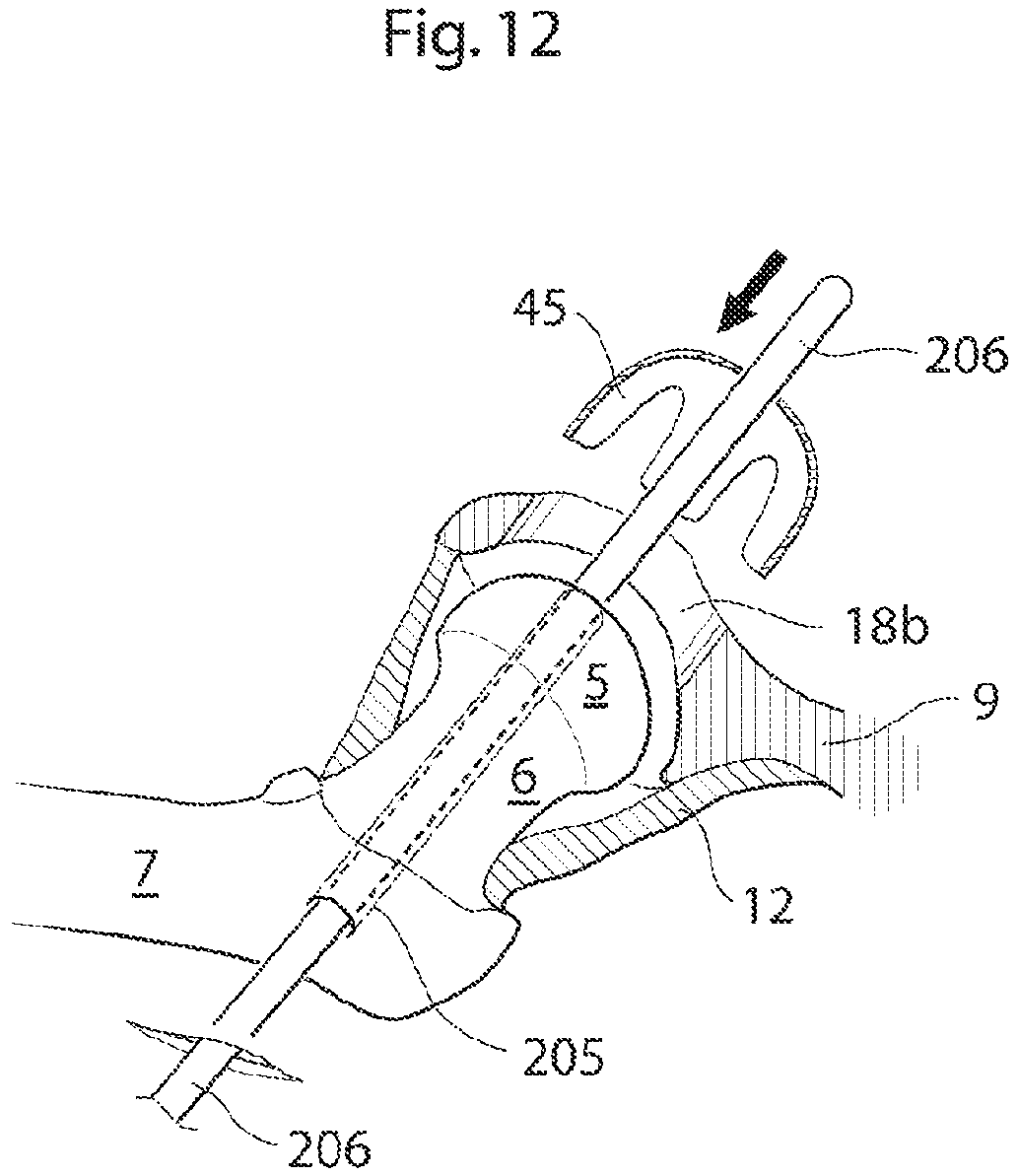 Patent US12137920 Figure 11 – Medical device and method for treatment of hip joint
