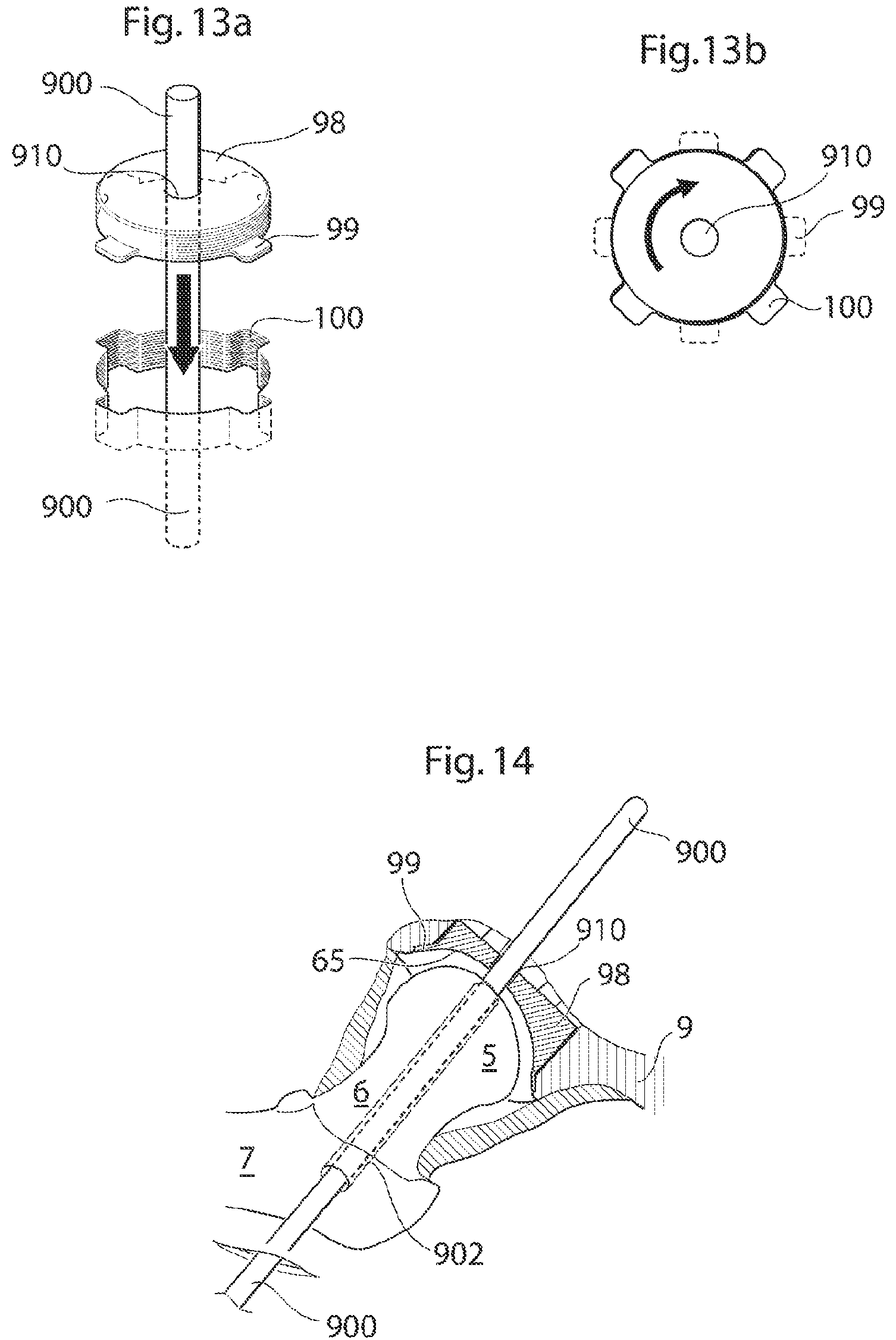 Patent US12137920 Figure 12 – Medical device and method for treatment of hip joint