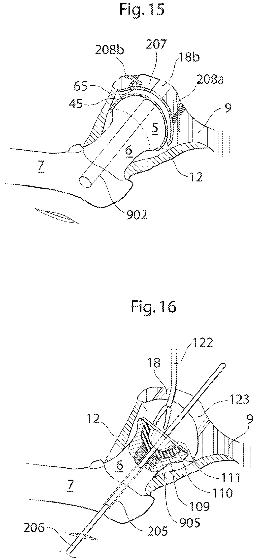 Patent US12137920 Figure 13 – Medical device and method for treatment of hip joint