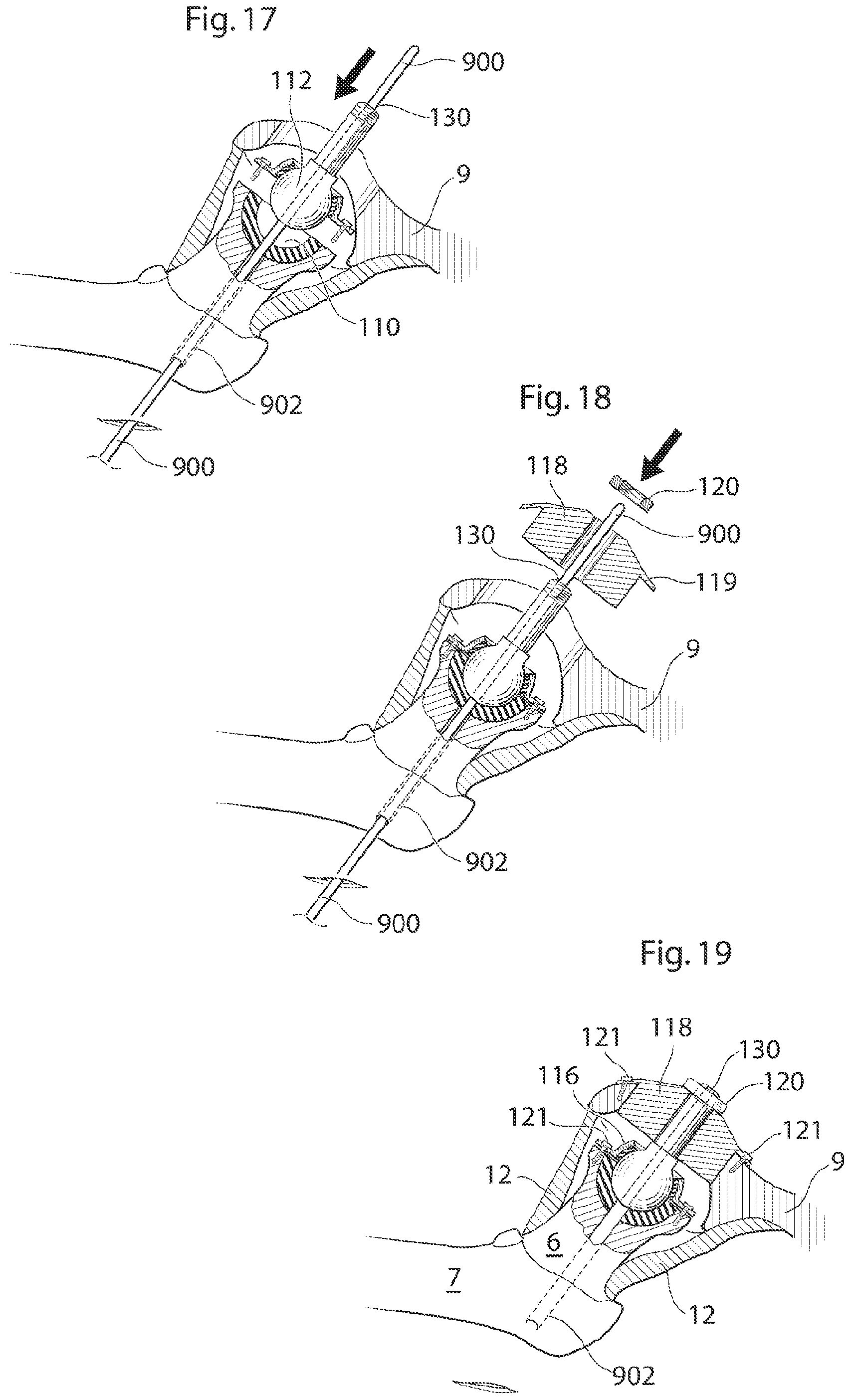 Patent US12137920 Figure 14 – Medical device and method for treatment of hip joint