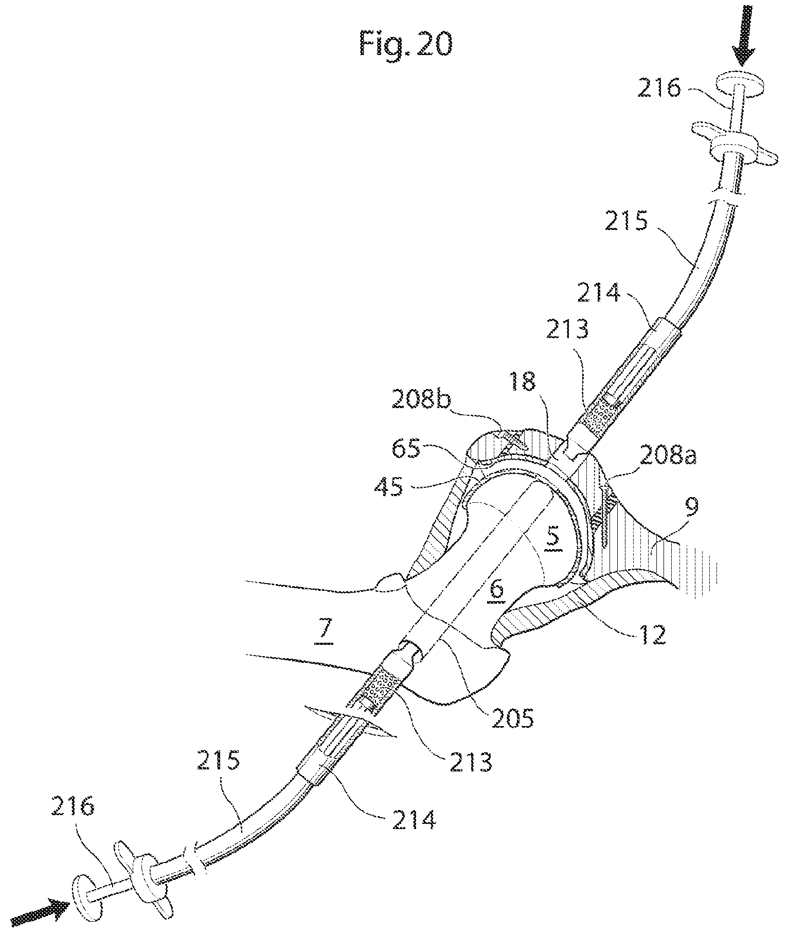 Patent US12137920 Figure 15 – Medical device and method for treatment of hip joint