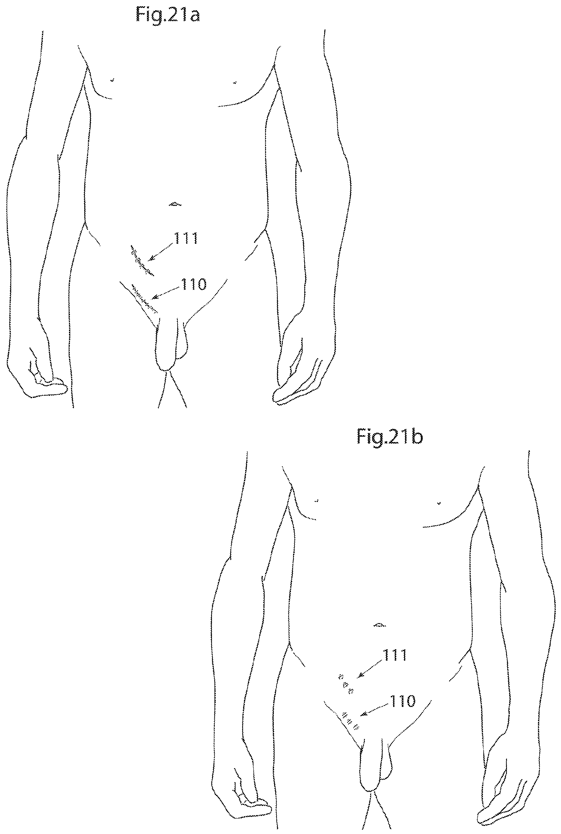 Patent US12137920 Figure 16 – Medical device and method for treatment of hip joint