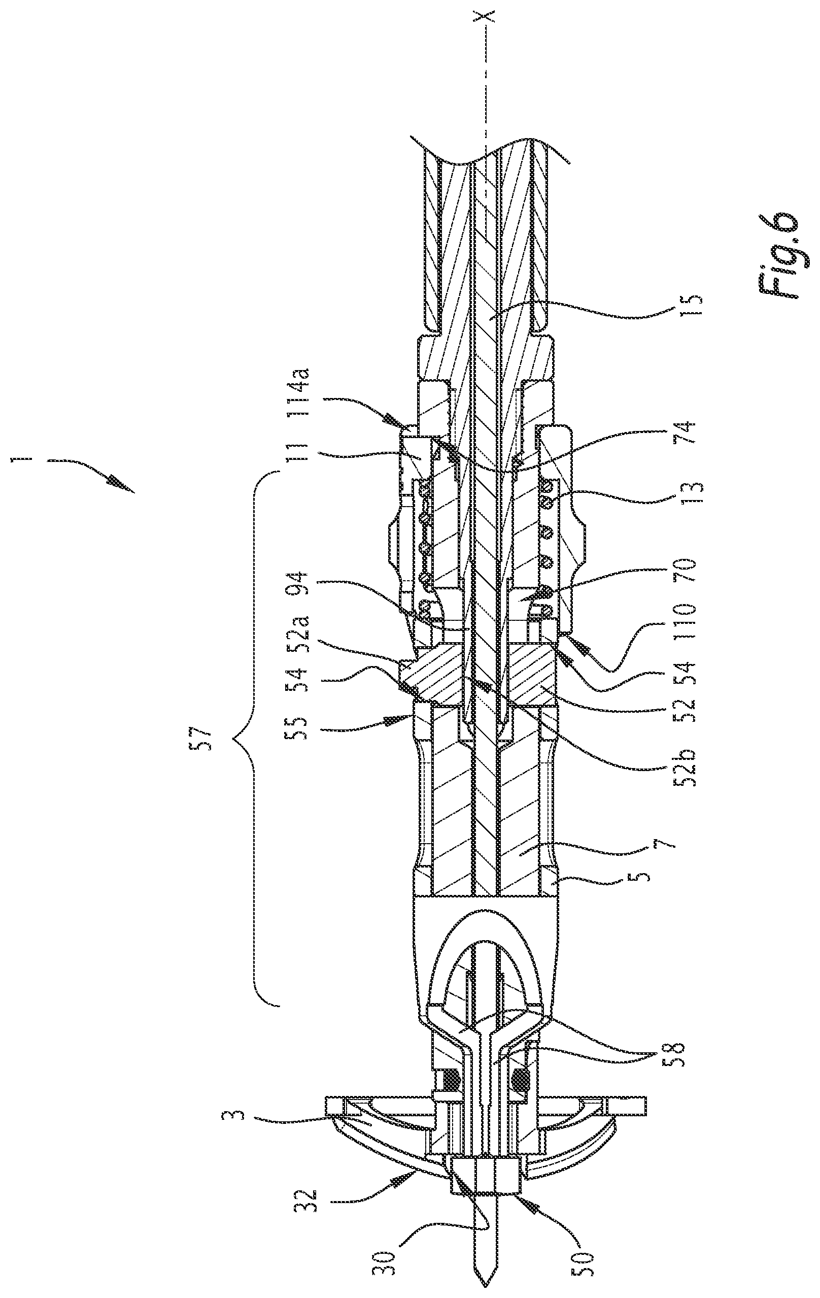 Patent US12137921 Figure 4 – Surgical bone preparation instrument and assembly comprising such an instrument