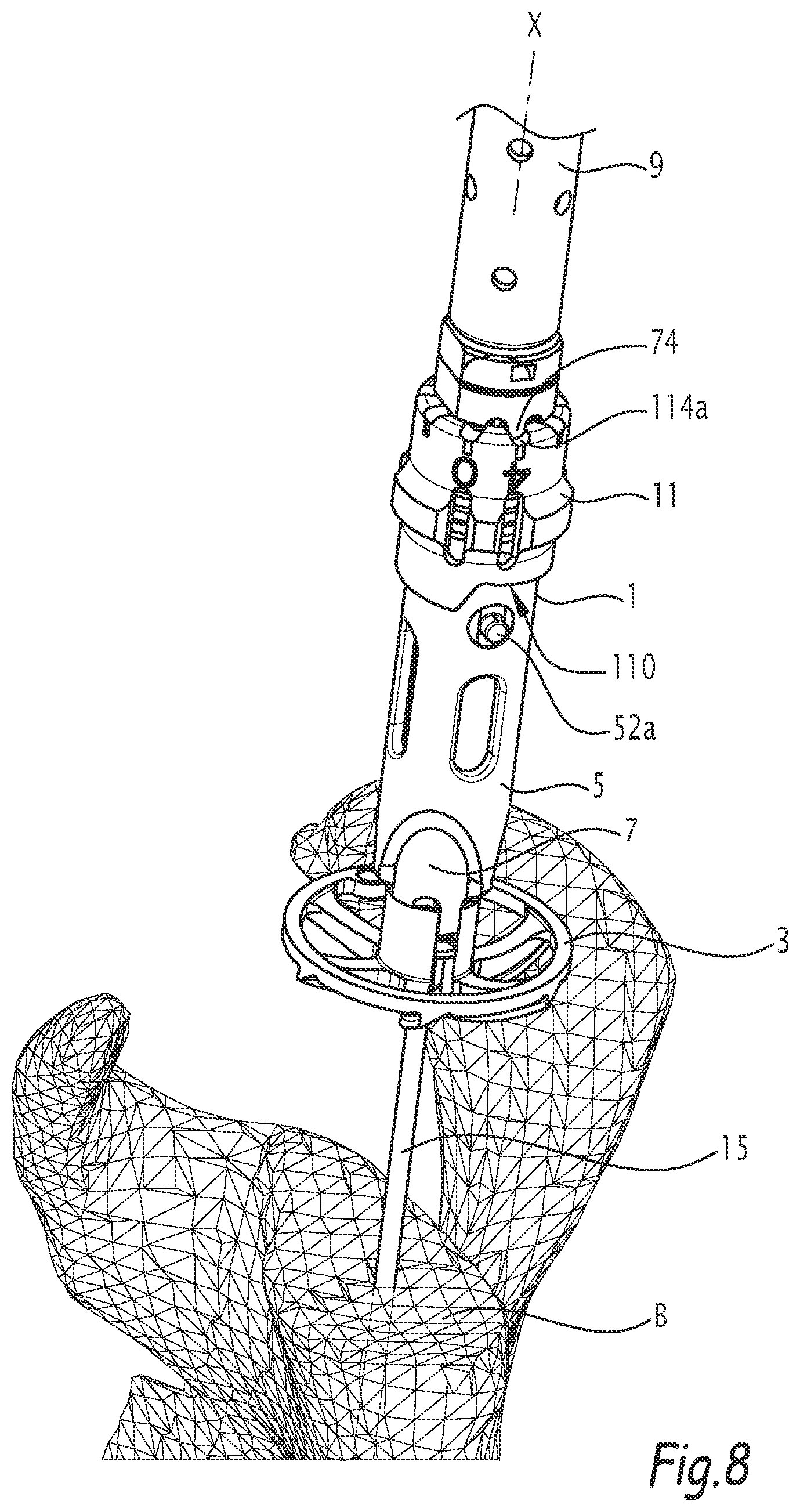 Patent US12137921 Figure 6 – Surgical bone preparation instrument and assembly comprising such an instrument
