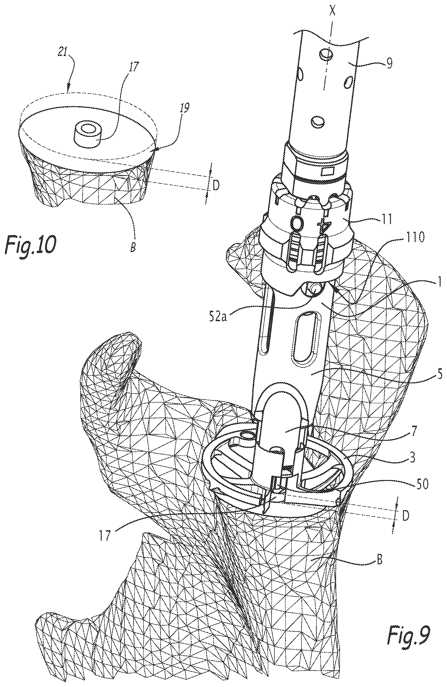 Patent US12137921 Figure 7 – Surgical bone preparation instrument and assembly comprising such an instrument