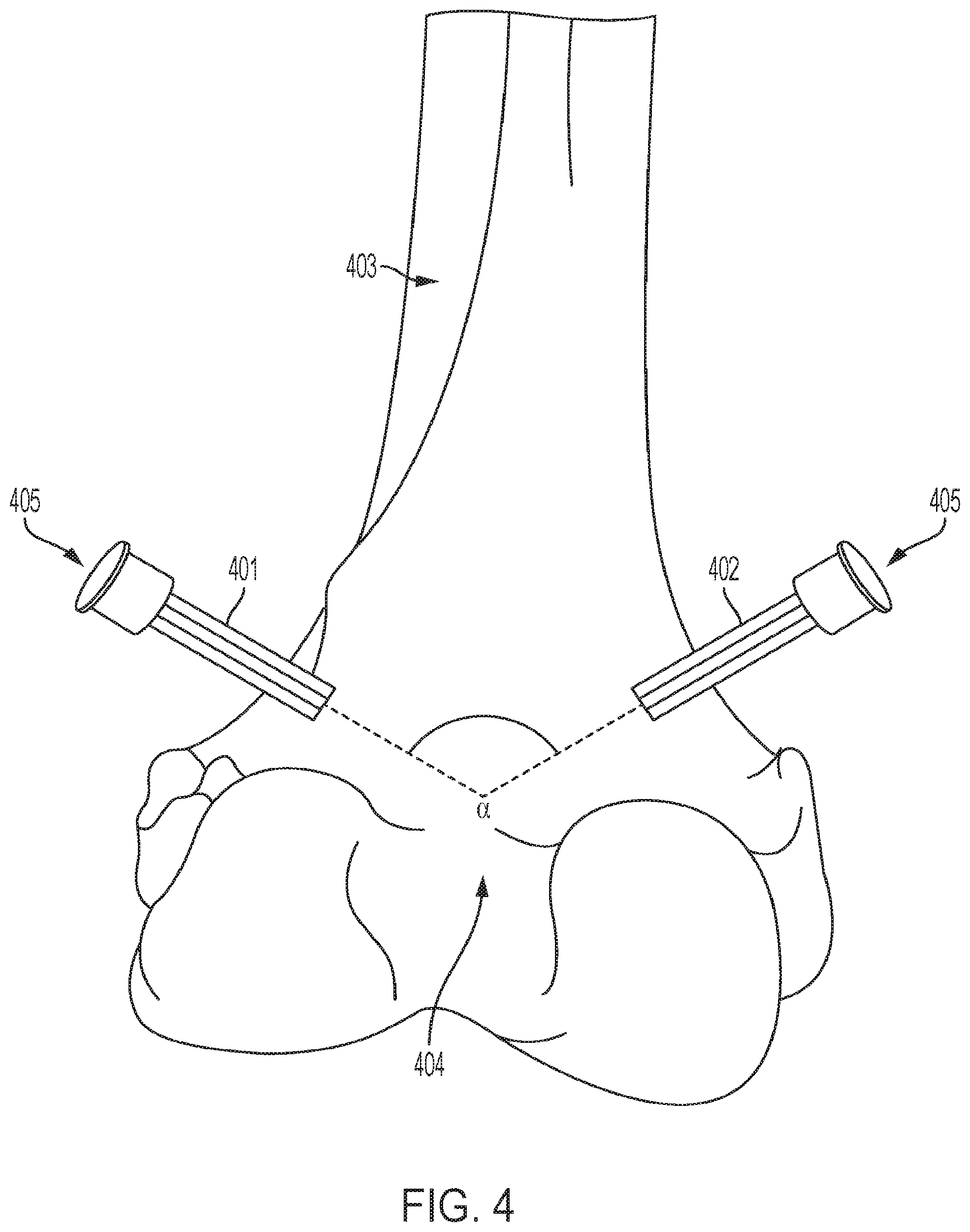 Patent US12137922 Figure 4 – Patient-specific guides for Latarjet procedure