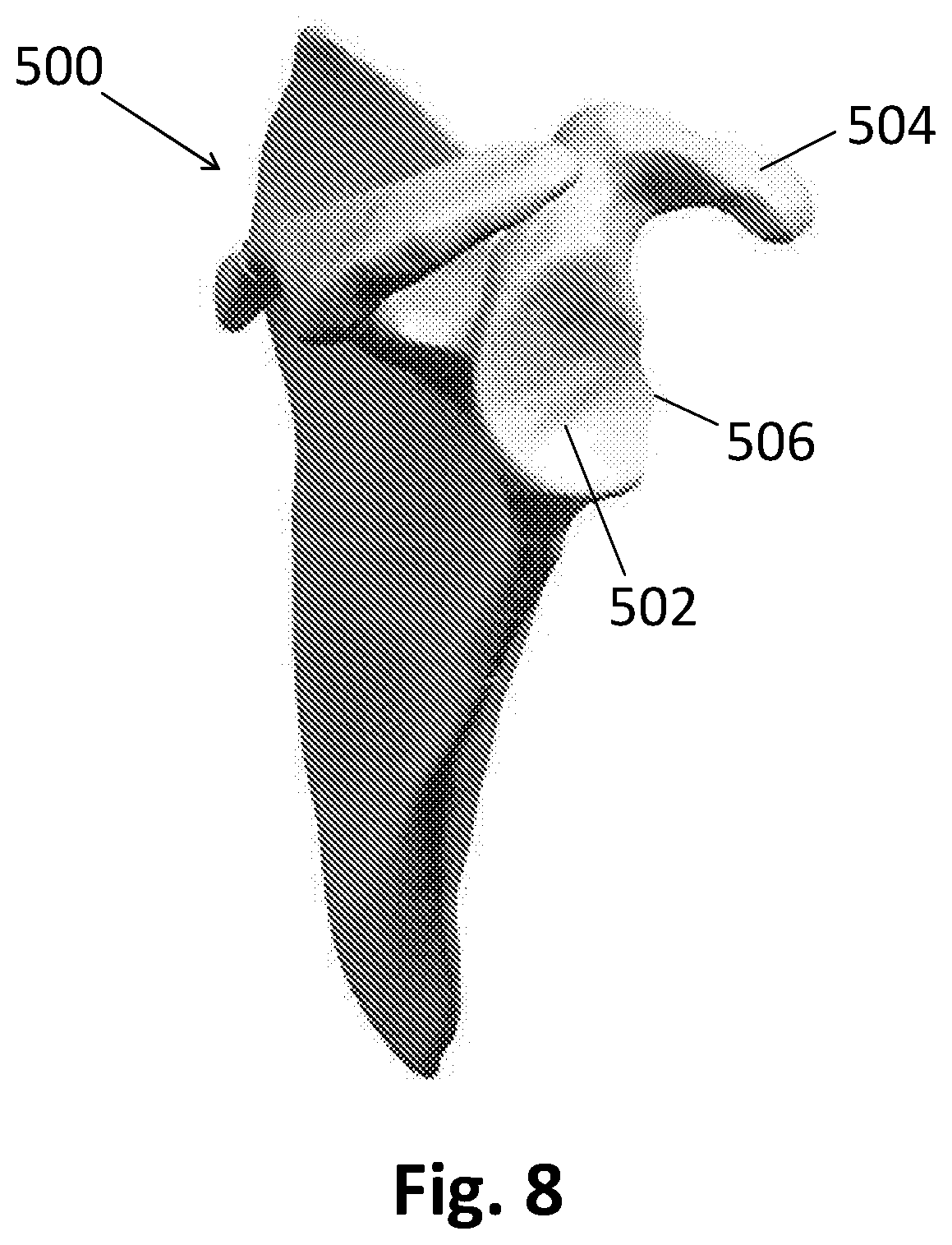 Patent US12137922 Figure 14 – Patient-specific guides for Latarjet procedure