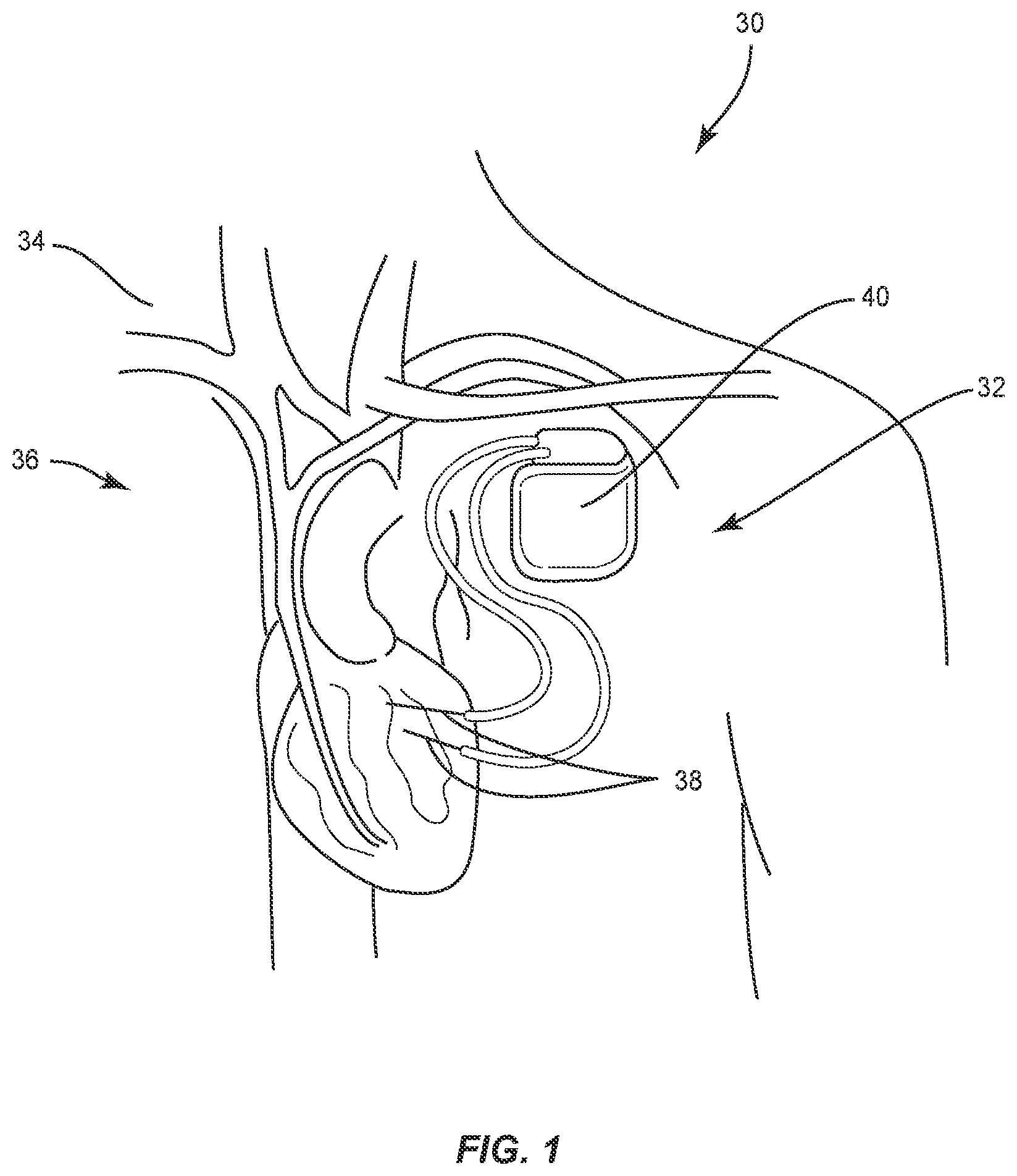 Patent US12137924 — Surgical system and methods — Figure 1