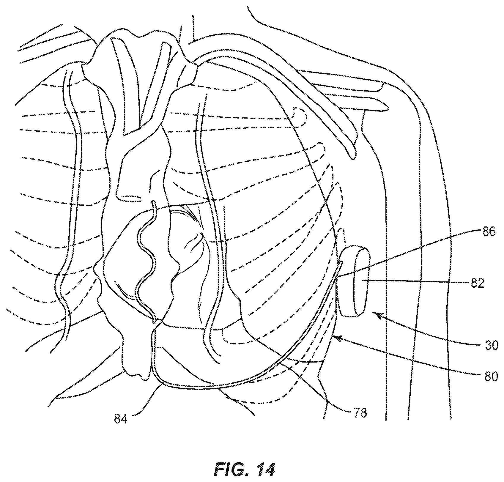 Patent US12137924 Figure 9 – Surgical system and methods