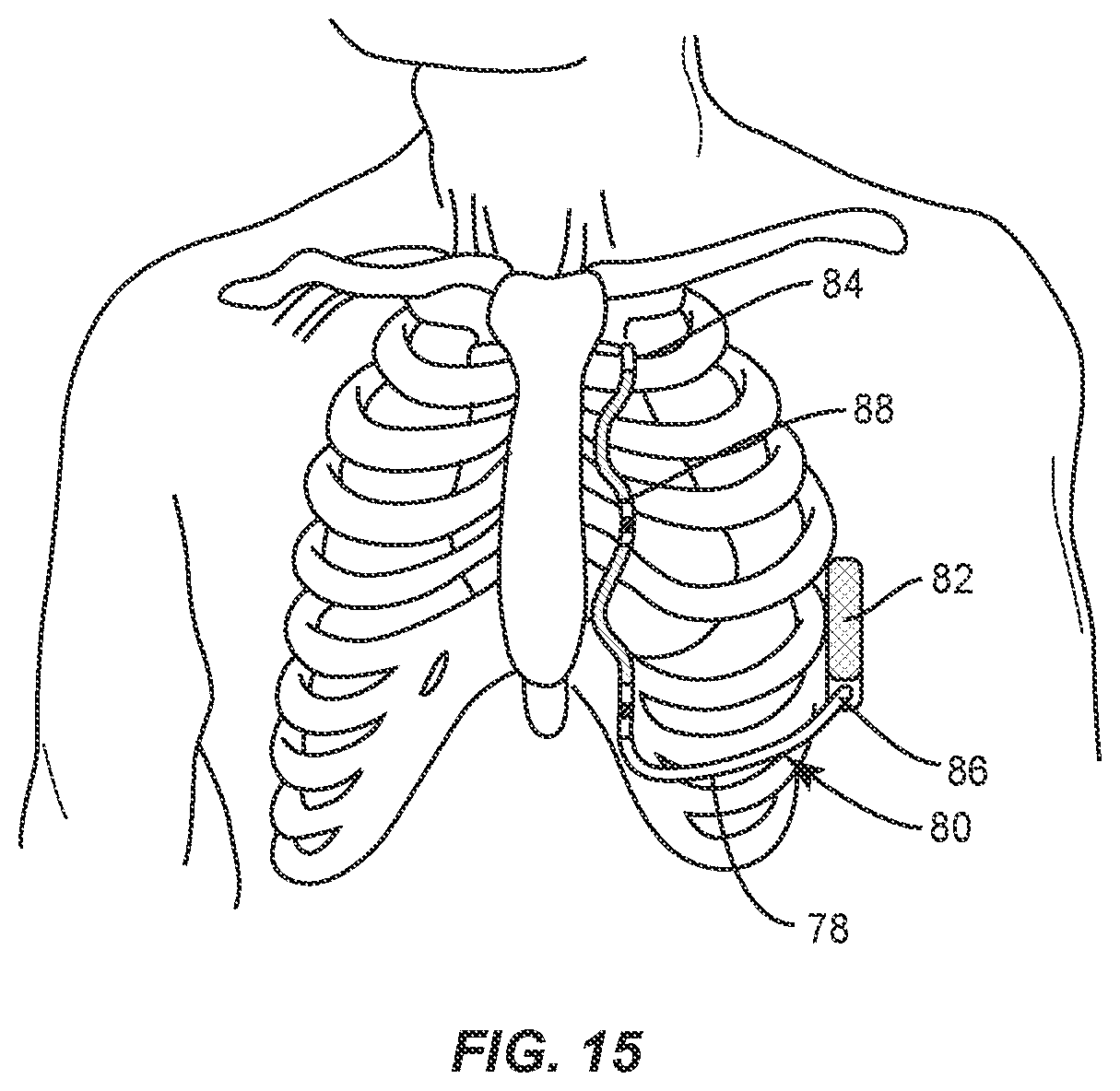 Patent US12137924 Figure 10 – Surgical system and methods