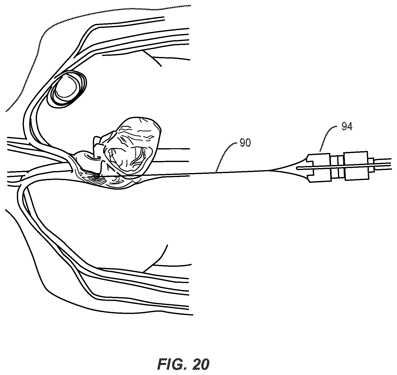 Patent US12137924 Figure 14 – Surgical system and methods