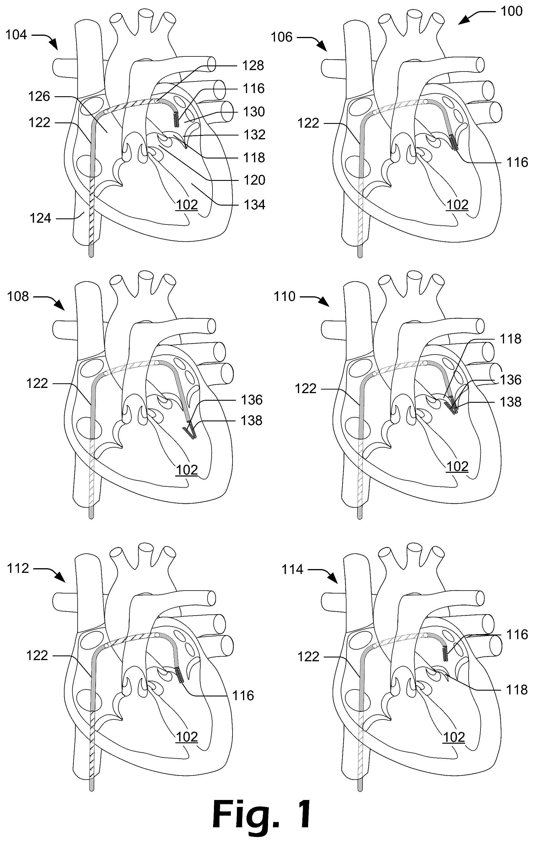 Patent US12137927 Figure 1 – Cutting grasper for valve leaflet laceration