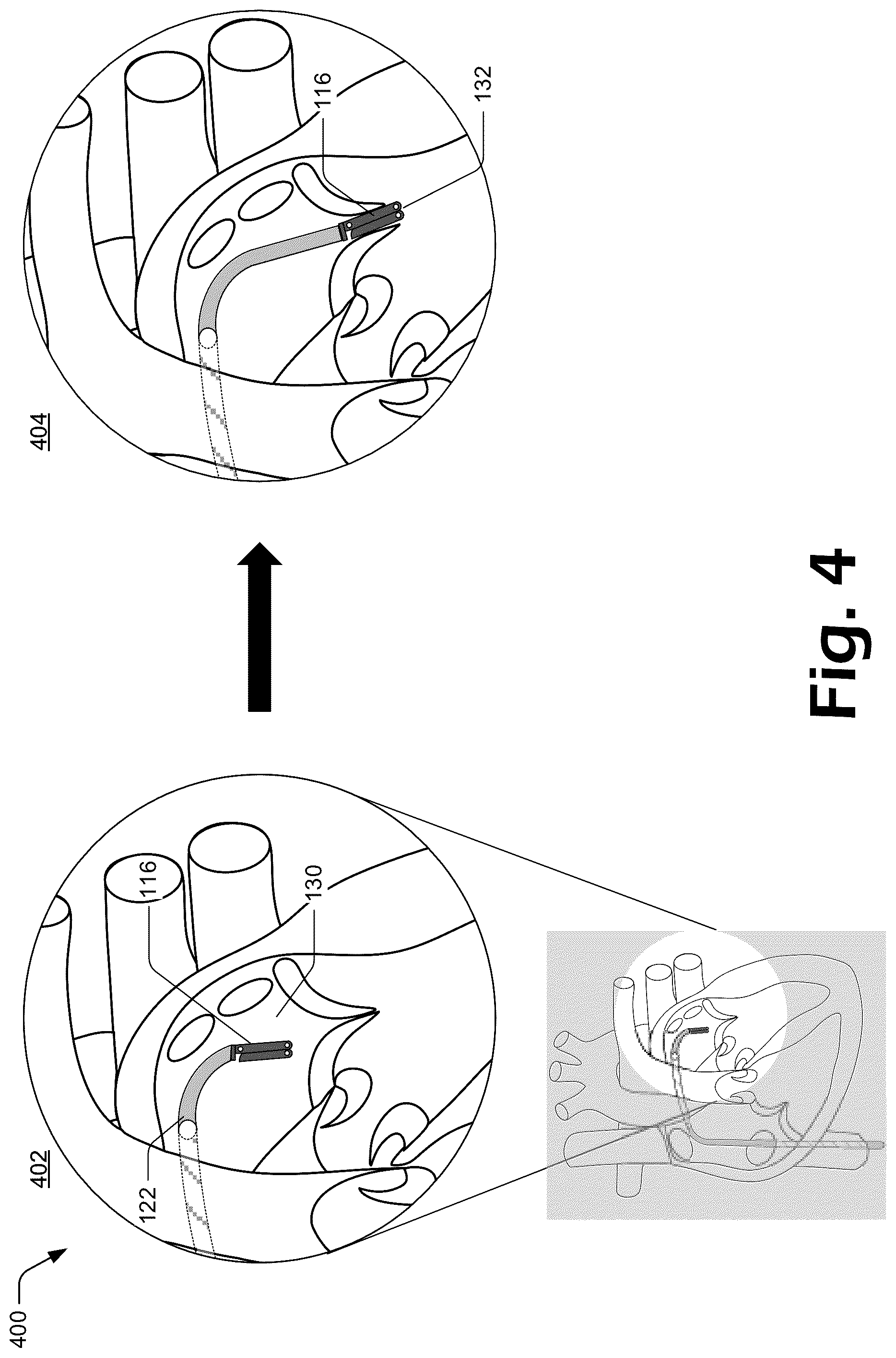 Patent US12137927 Figure 4 – Cutting grasper for valve leaflet laceration
