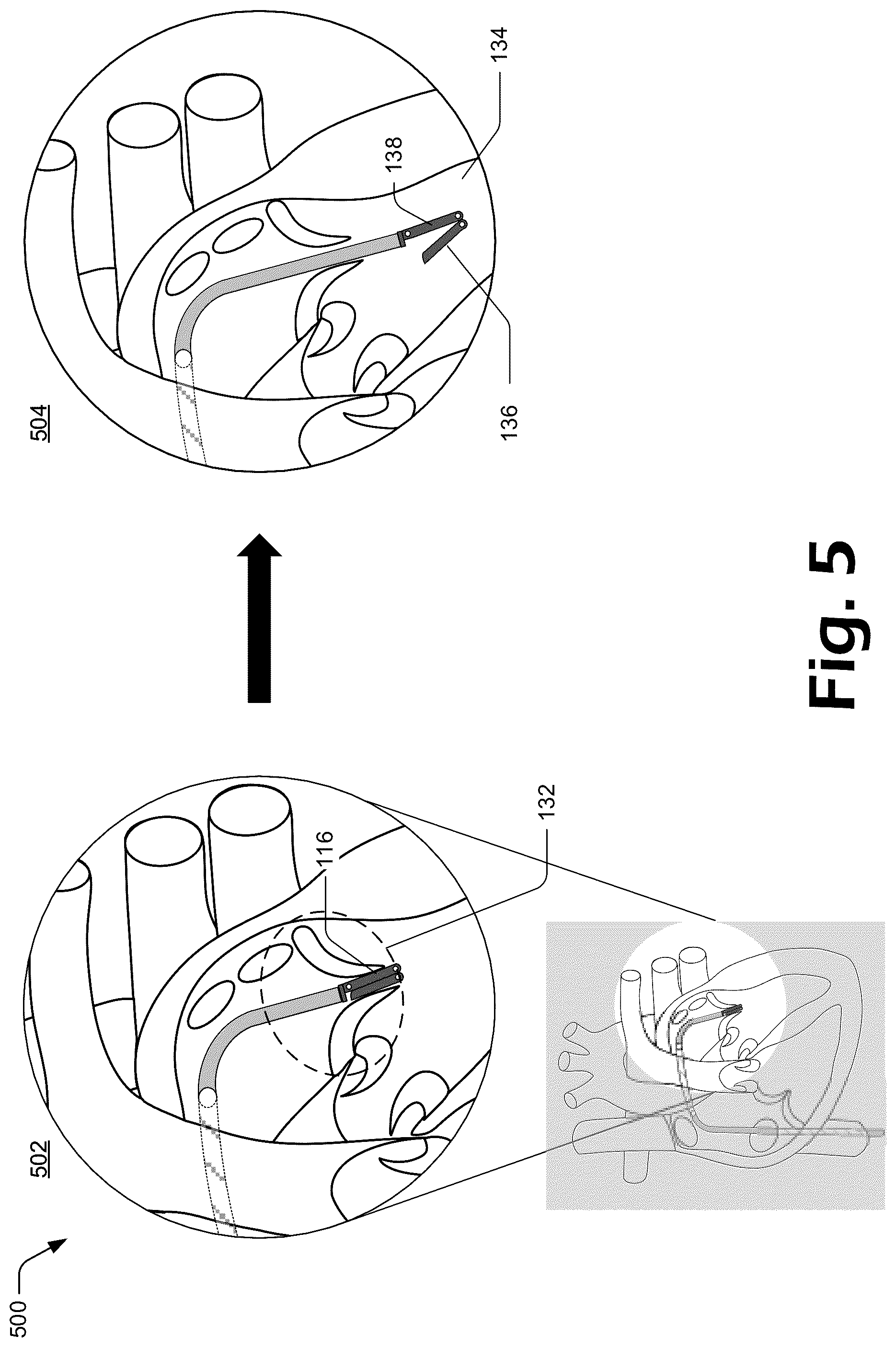 Patent US12137927 Figure 5 – Cutting grasper for valve leaflet laceration