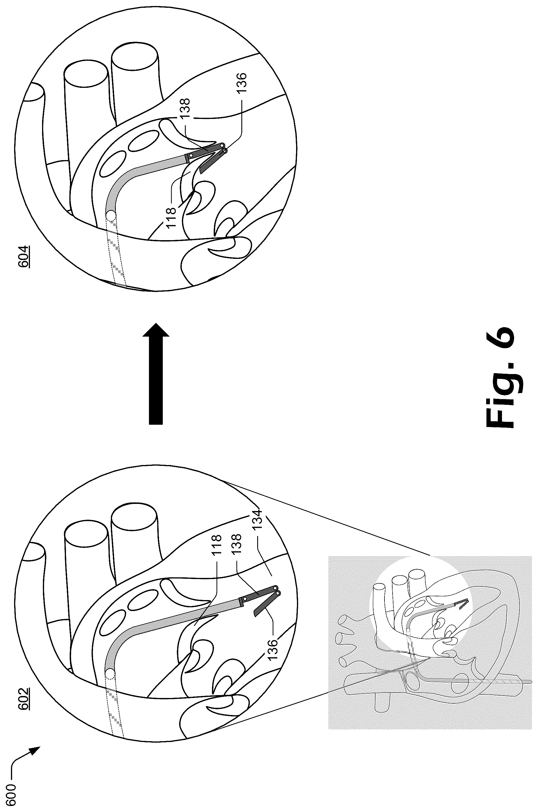 Patent US12137927 Figure 6 – Cutting grasper for valve leaflet laceration