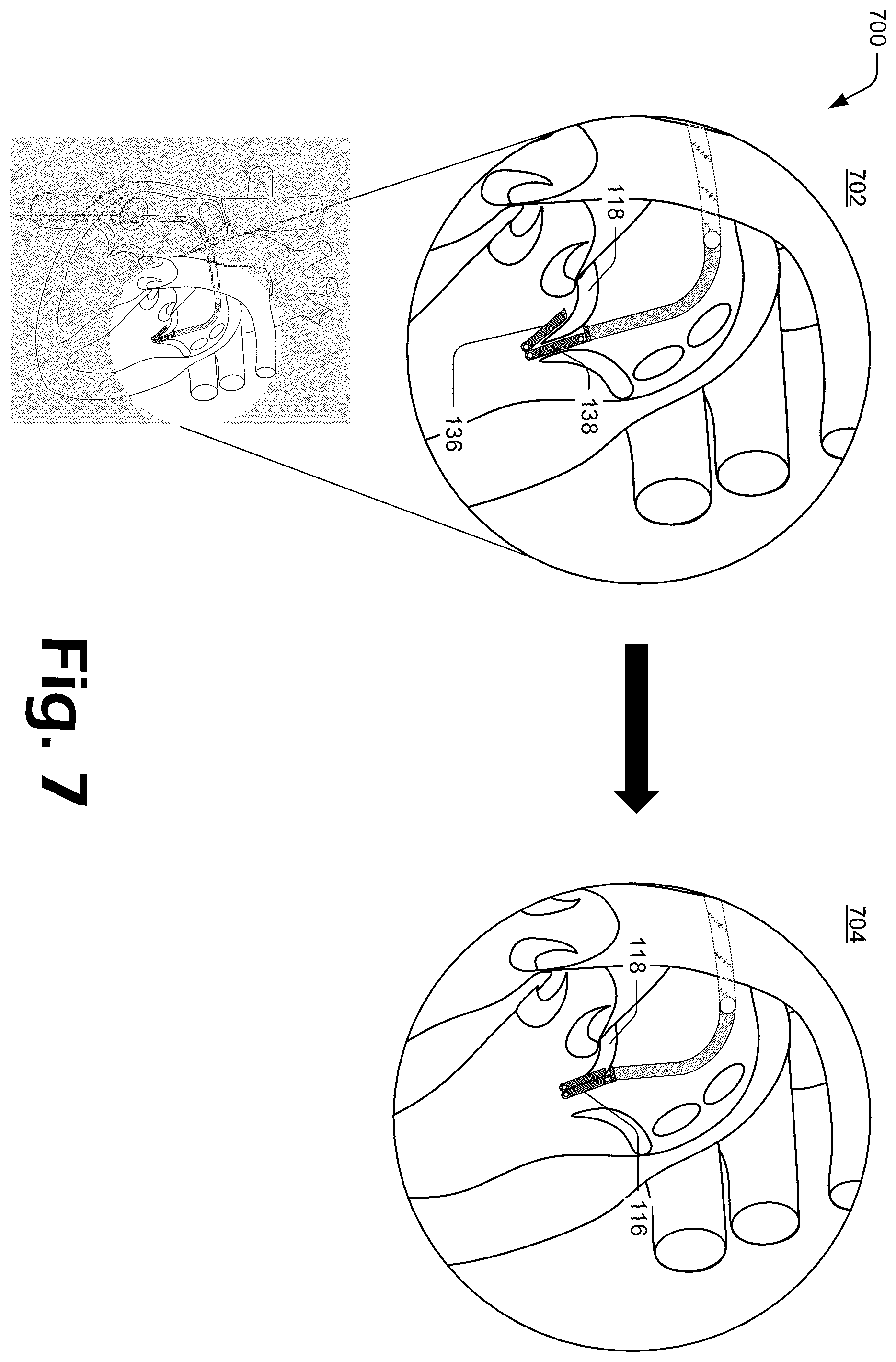 Patent US12137927 Figure 7 – Cutting grasper for valve leaflet laceration