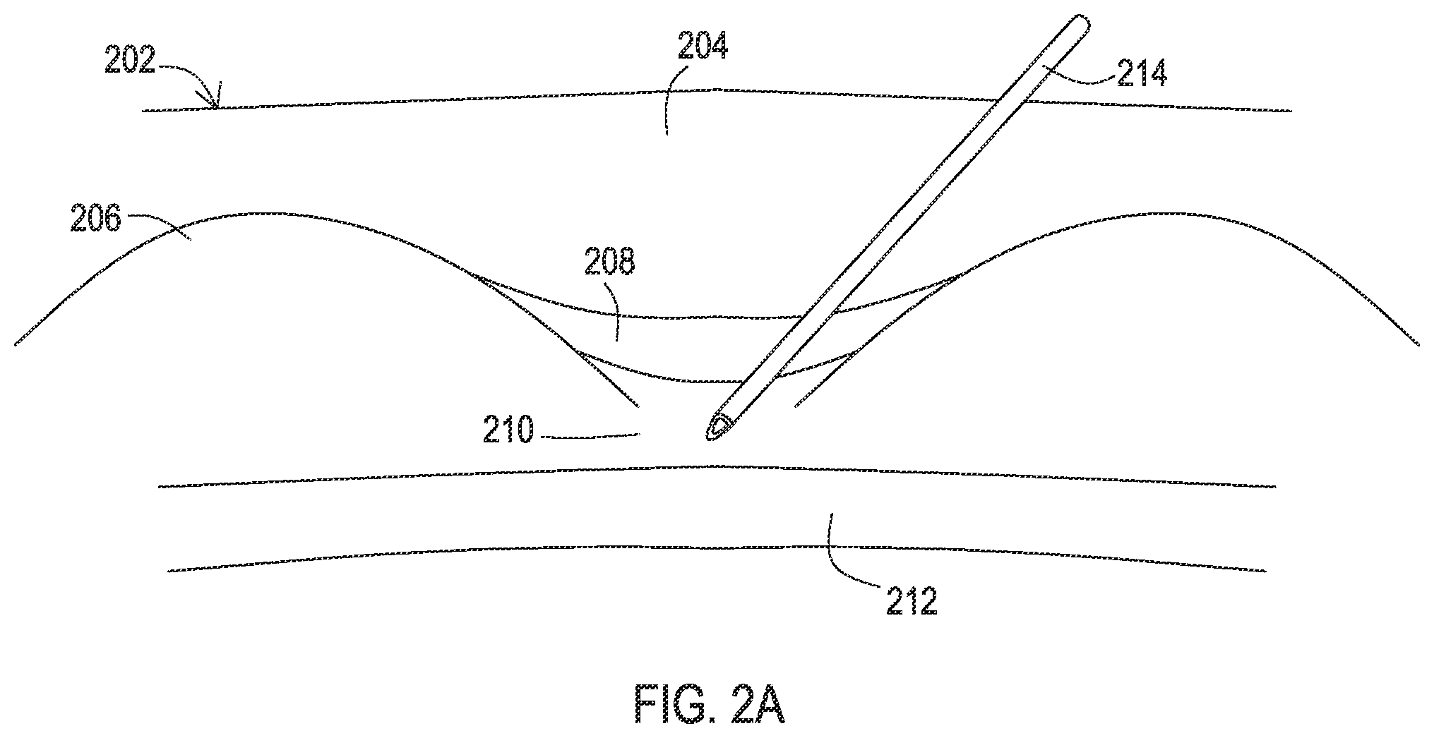 Patent US12137932 Figure 4 – Medical assemblies and methods for implantation of multiple medical leads through a single entry