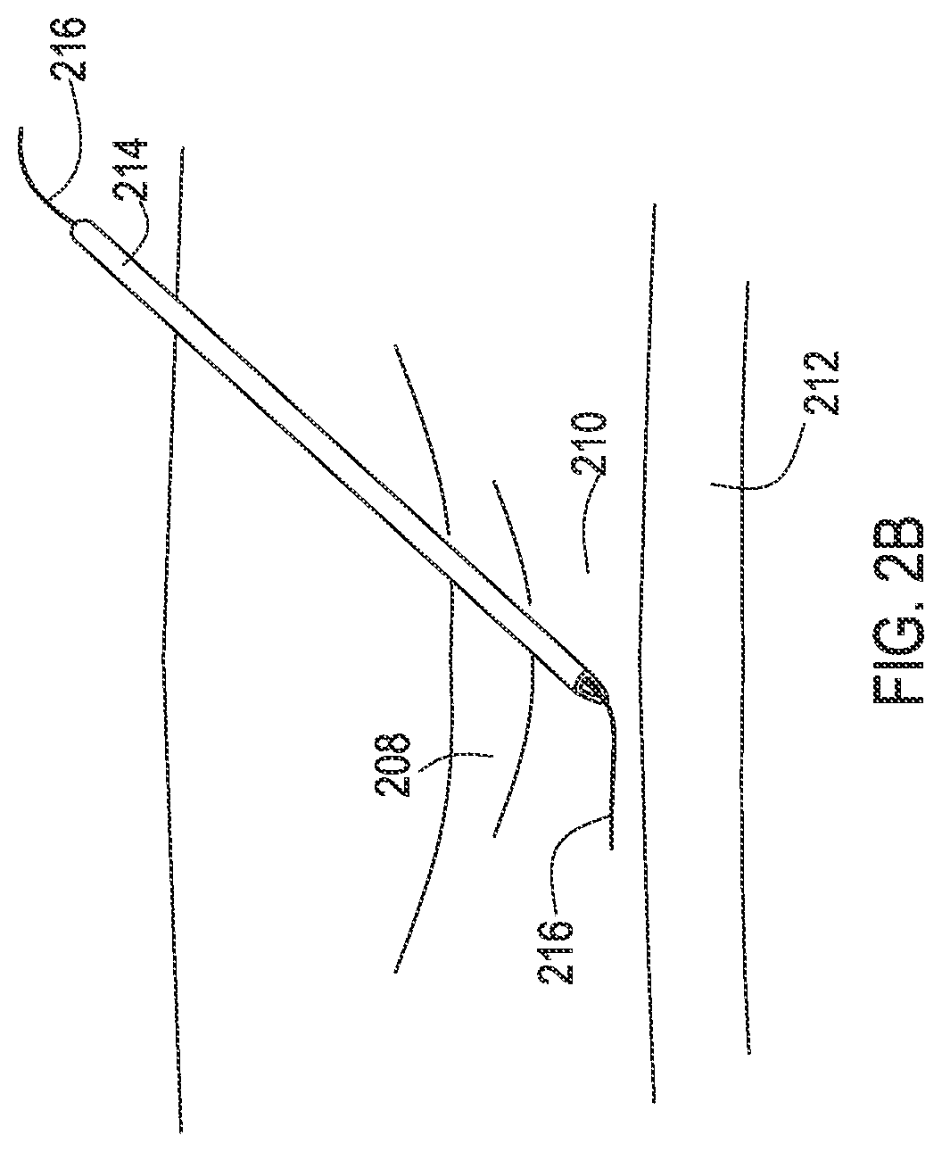 Patent US12137932 Figure 5 – Medical assemblies and methods for implantation of multiple medical leads through a single entry