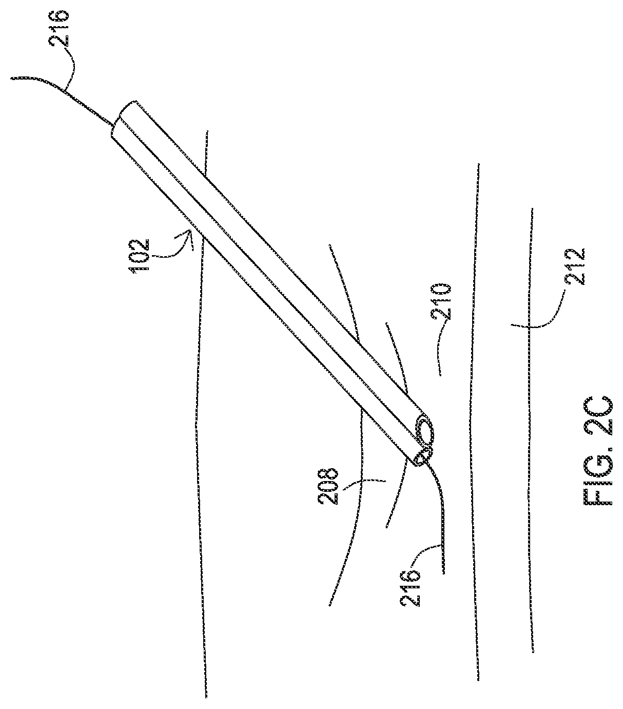Patent US12137932 Figure 6 – Medical assemblies and methods for implantation of multiple medical leads through a single entry