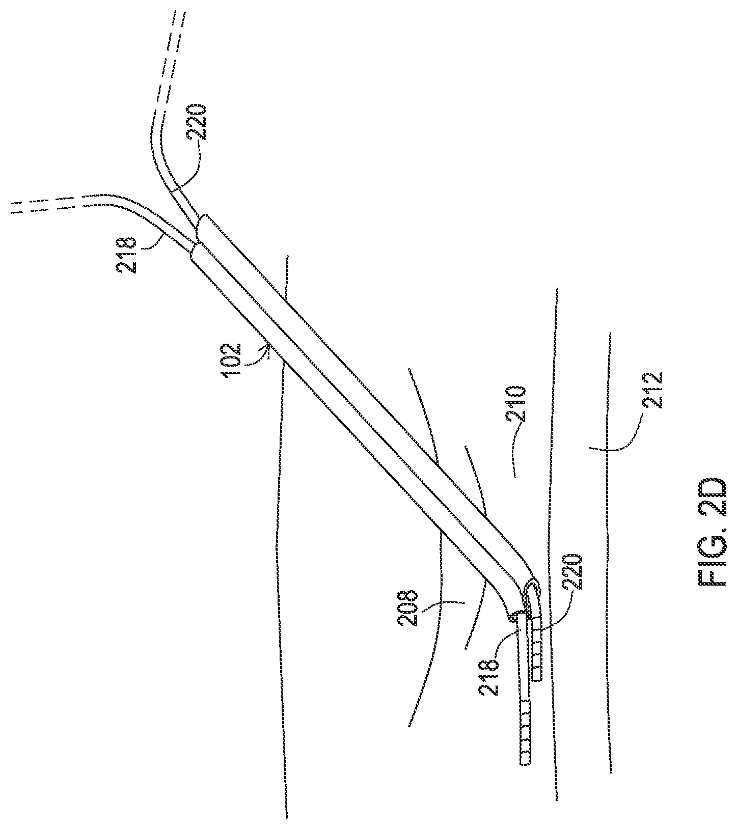 Patent US12137932 Figure 7 – Medical assemblies and methods for implantation of multiple medical leads through a single entry