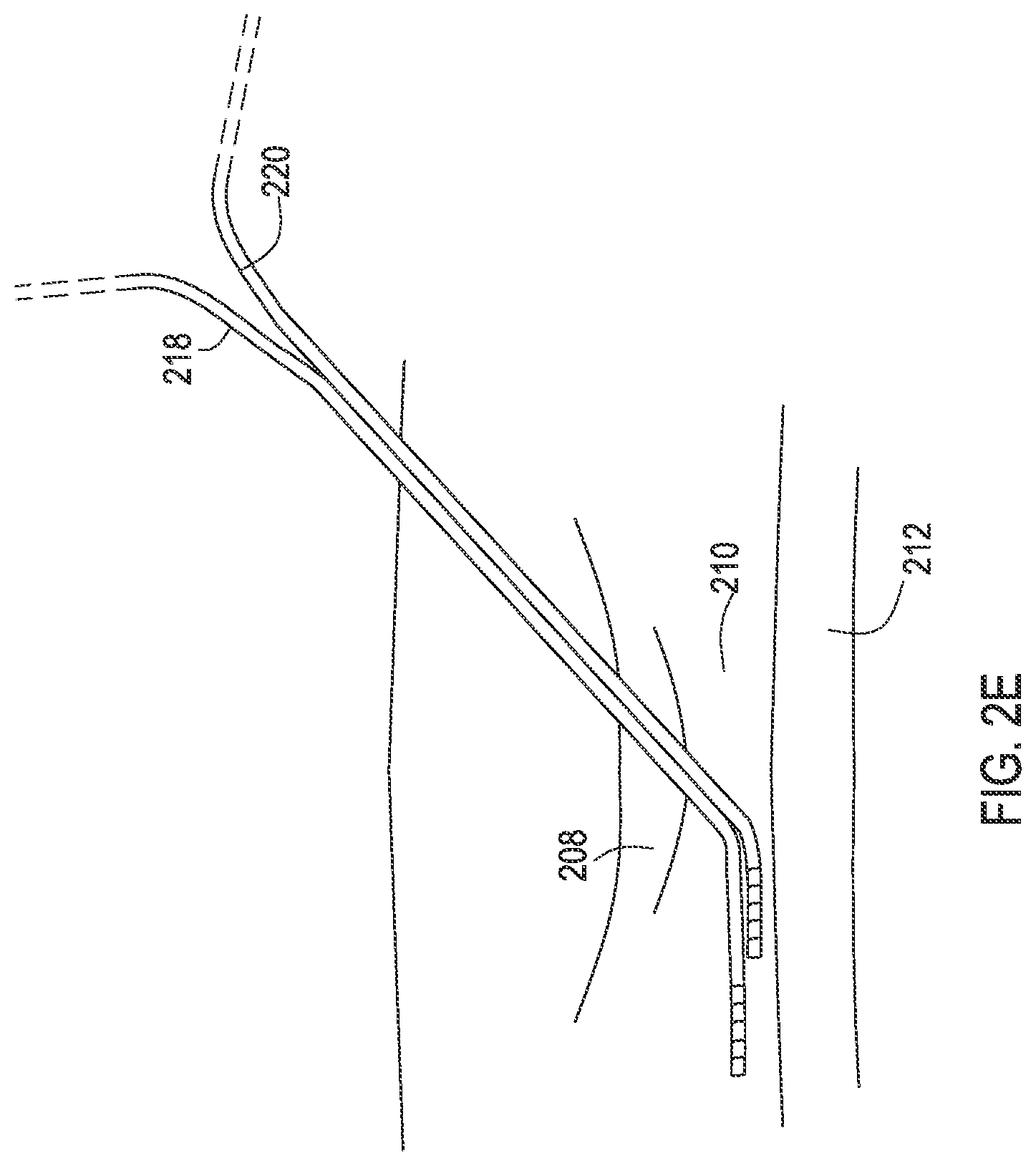 Patent US12137932 Figure 8 – Medical assemblies and methods for implantation of multiple medical leads through a single entry