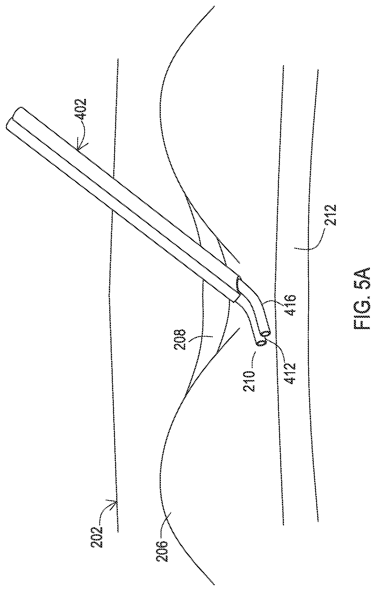 Patent US12137932 Figure 11 – Medical assemblies and methods for implantation of multiple medical leads through a single entry