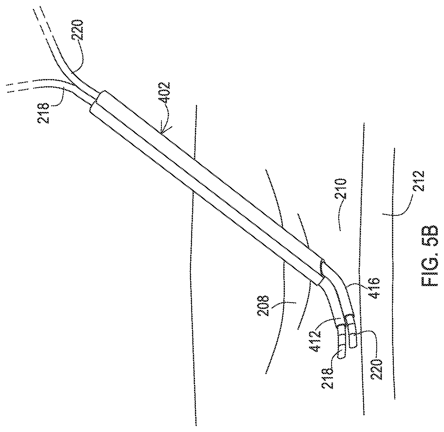 Patent US12137932 Figure 12 – Medical assemblies and methods for implantation of multiple medical leads through a single entry