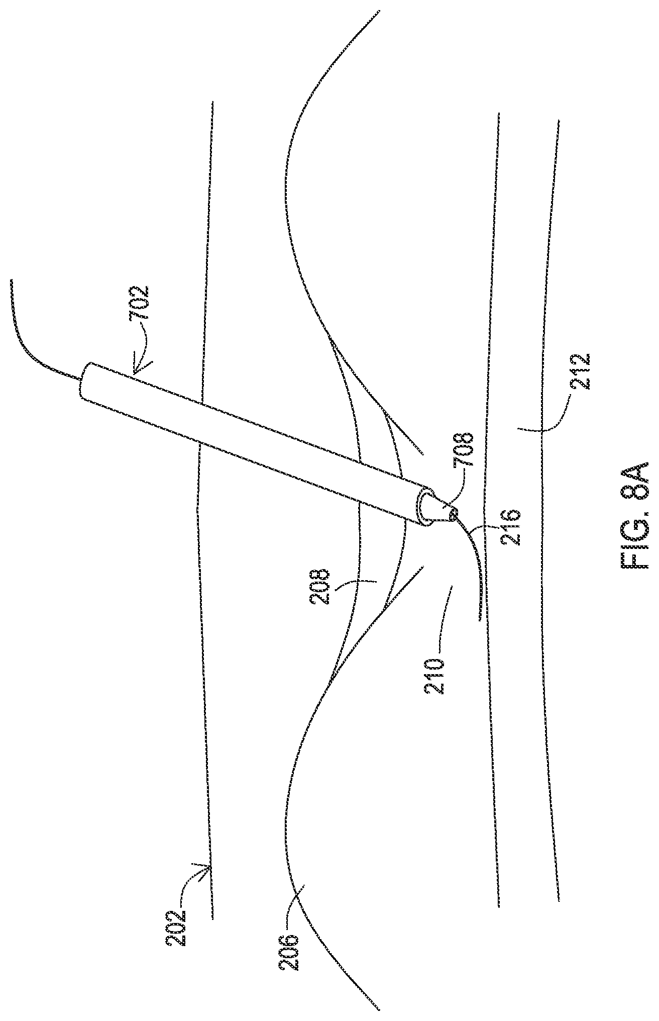Patent US12137932 Figure 16 – Medical assemblies and methods for implantation of multiple medical leads through a single entry