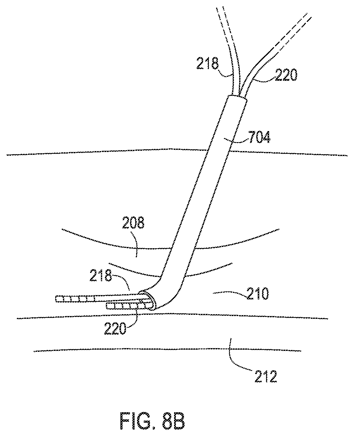 Patent US12137932 Figure 17 – Medical assemblies and methods for implantation of multiple medical leads through a single entry