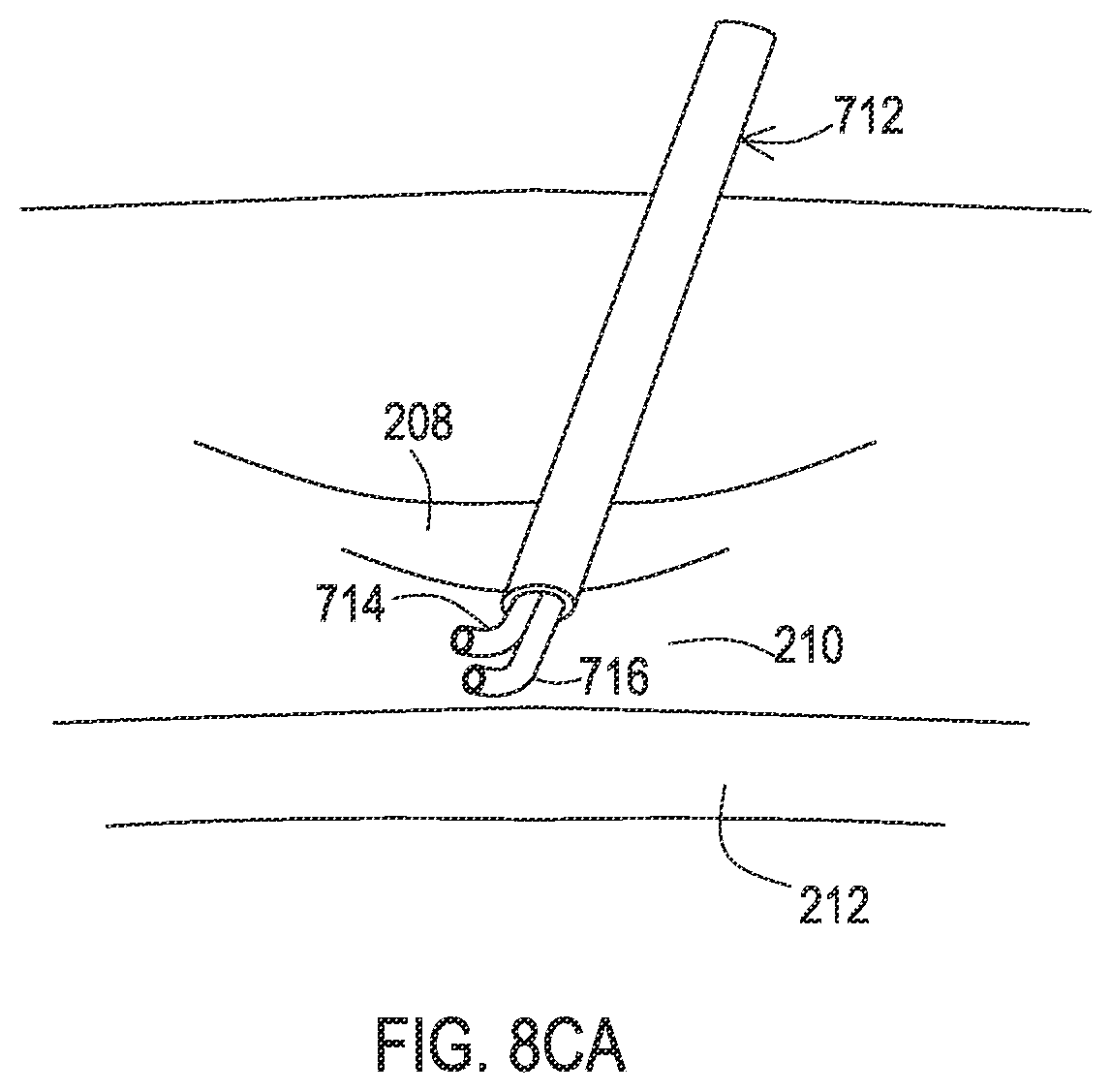 Patent US12137932 Figure 18 – Medical assemblies and methods for implantation of multiple medical leads through a single entry