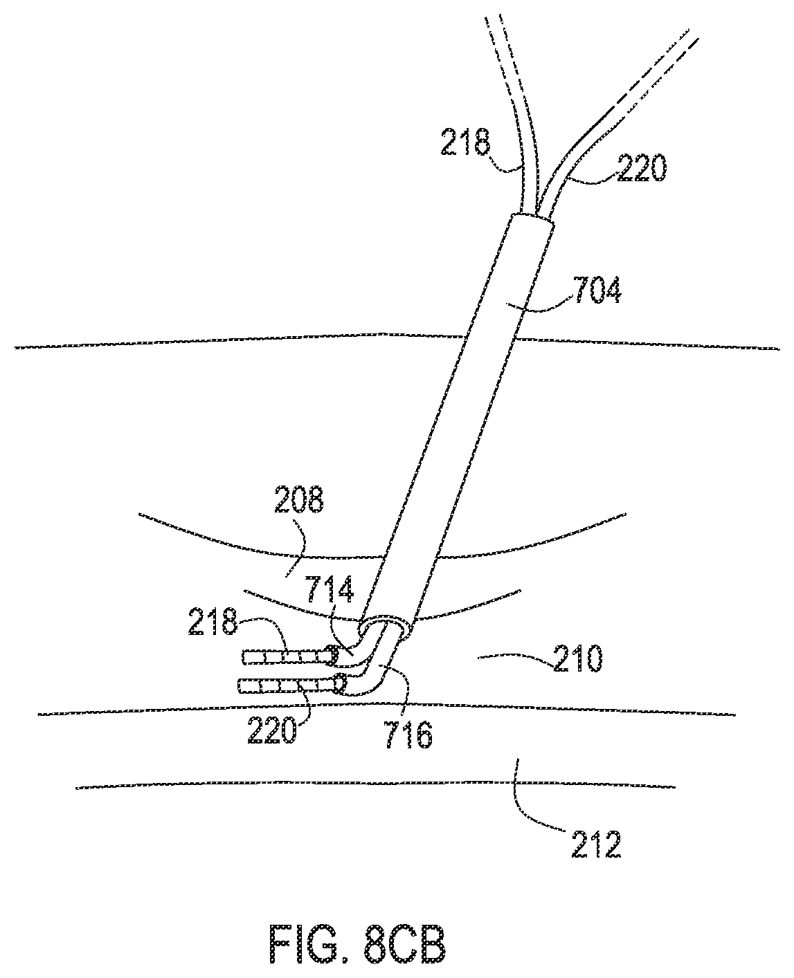 Patent US12137932 Figure 19 – Medical assemblies and methods for implantation of multiple medical leads through a single entry