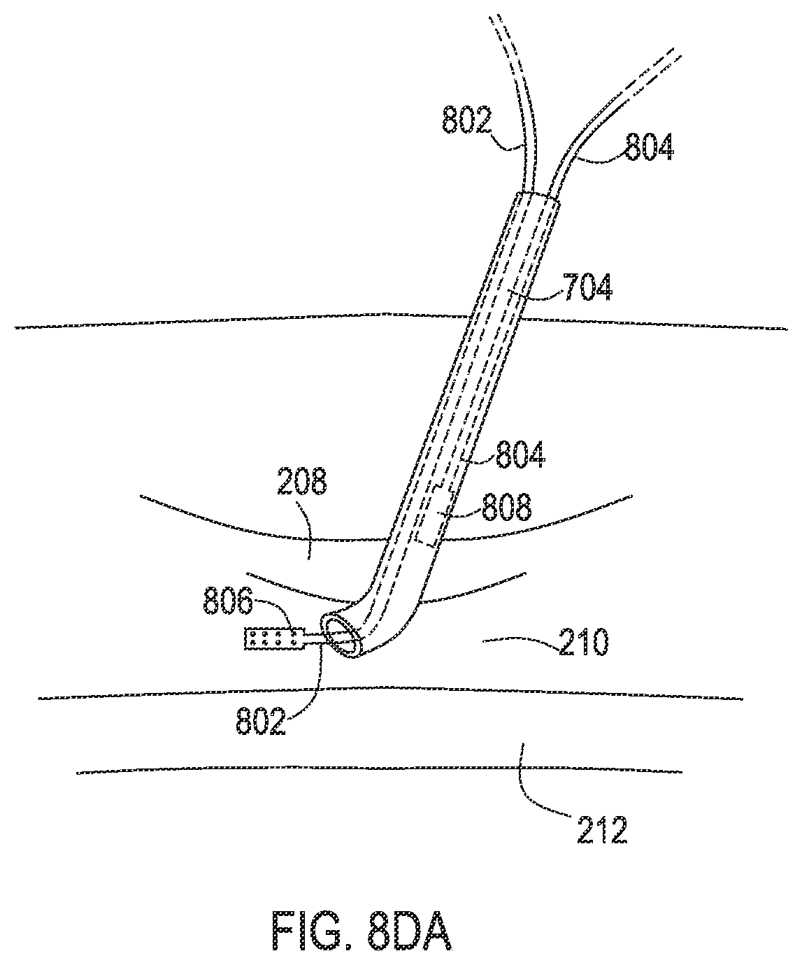 Patent US12137932 Figure 20 – Medical assemblies and methods for implantation of multiple medical leads through a single entry