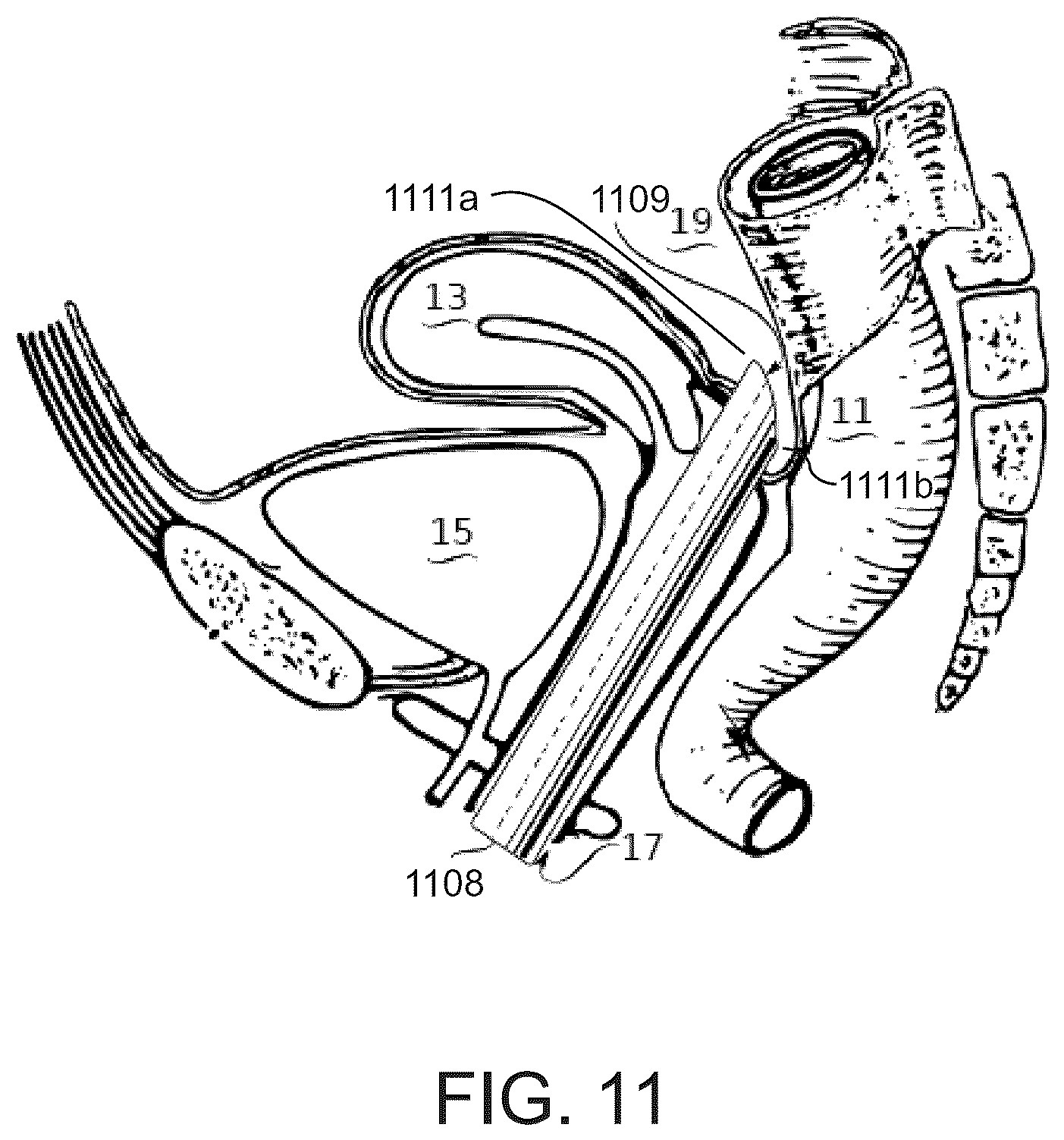 Patent US12137933 Figure 11 – Tools and methods for vaginal access