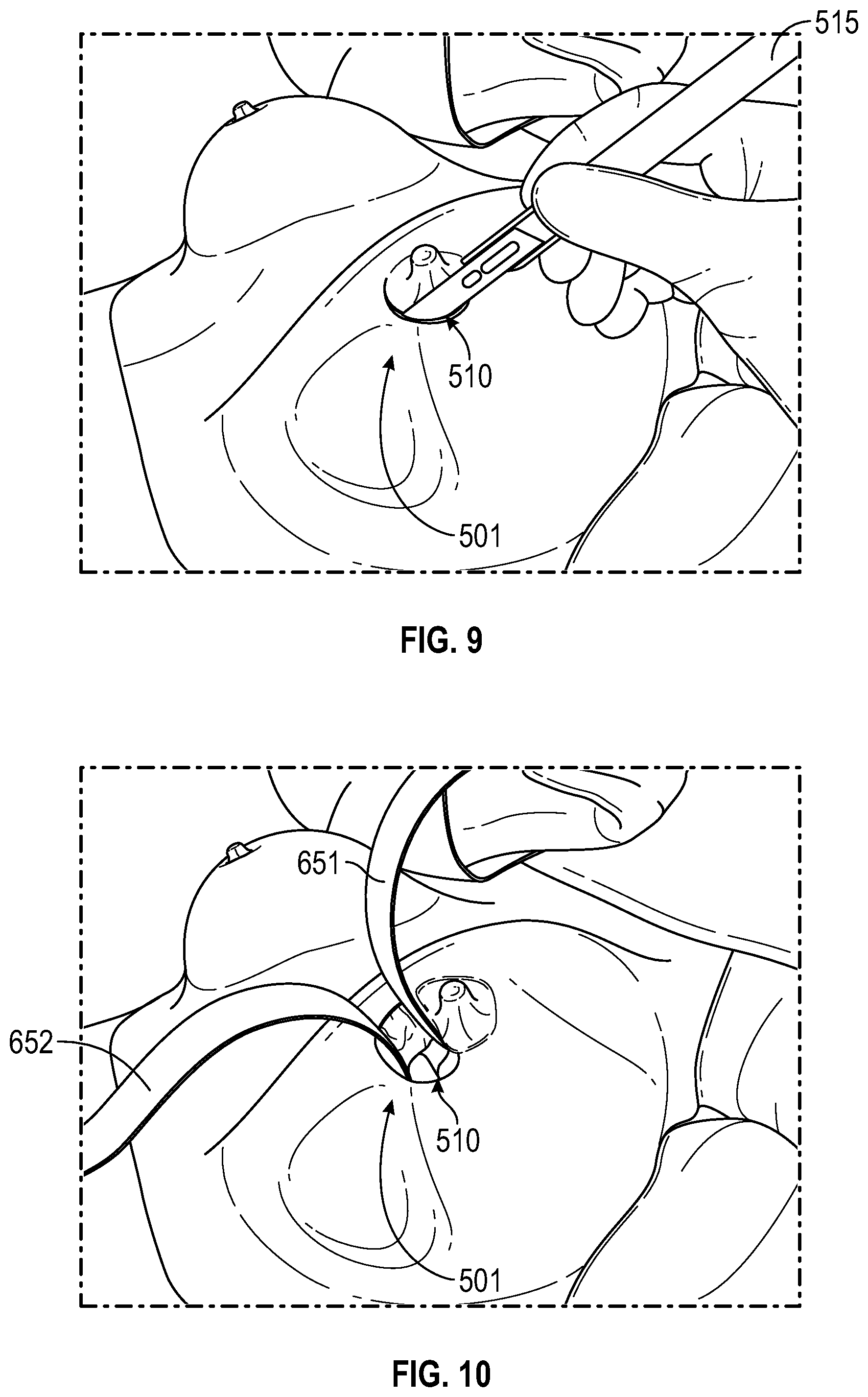 Patent US12137938 Figure 7 – Biofilm protection implant shield