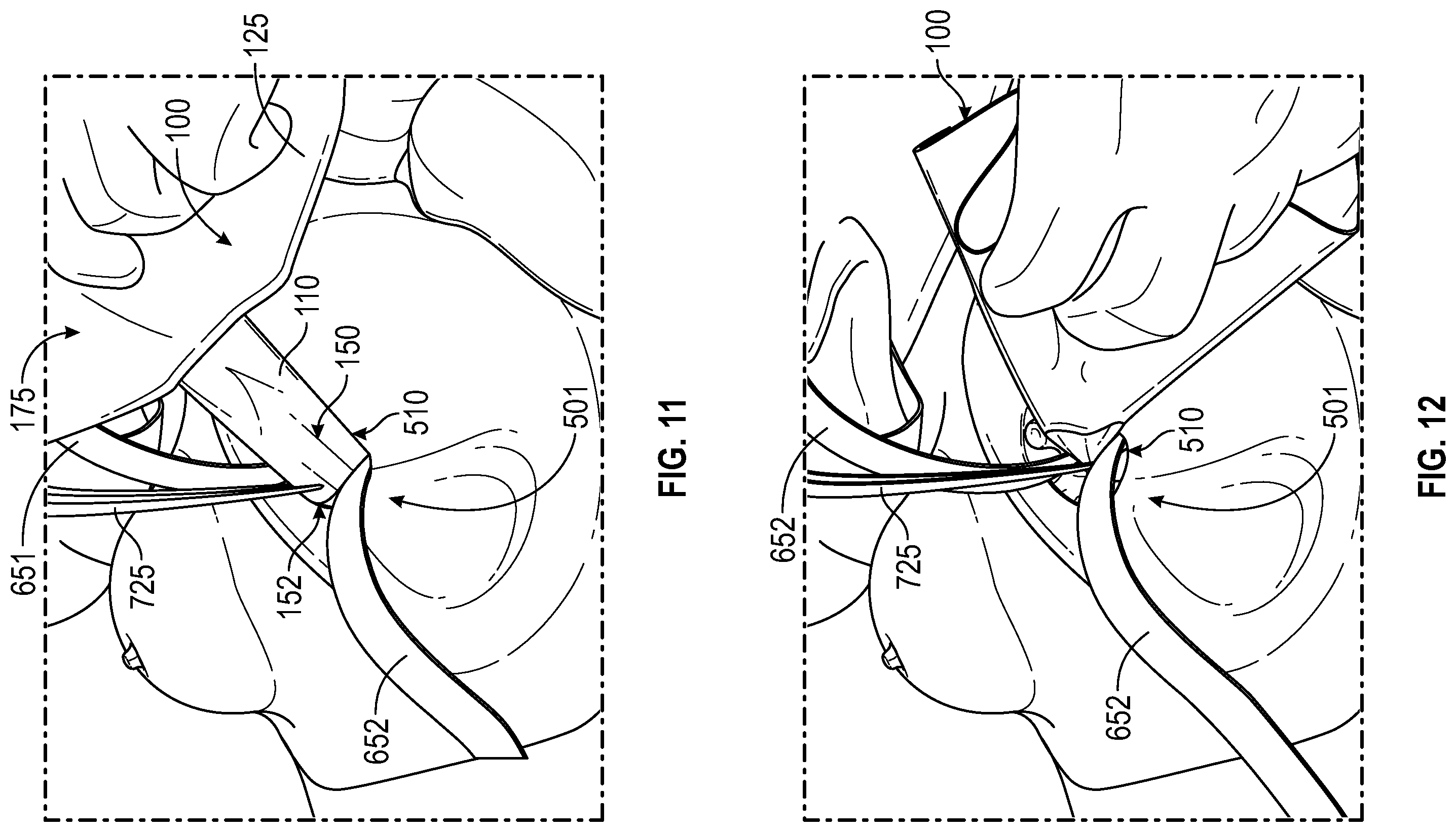 Patent US12137938 Figure 8 – Biofilm protection implant shield