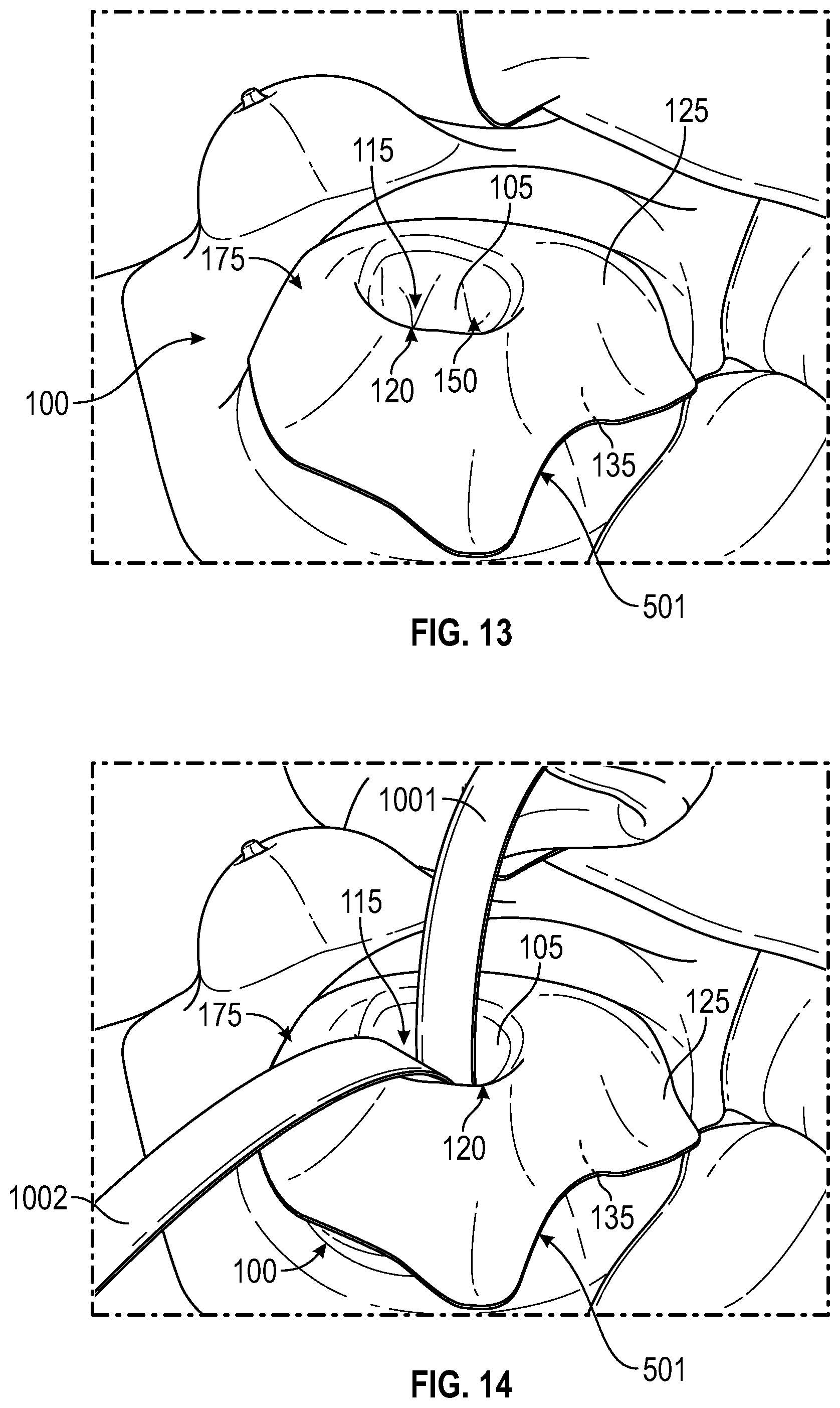 Patent US12137938 Figure 9 – Biofilm protection implant shield