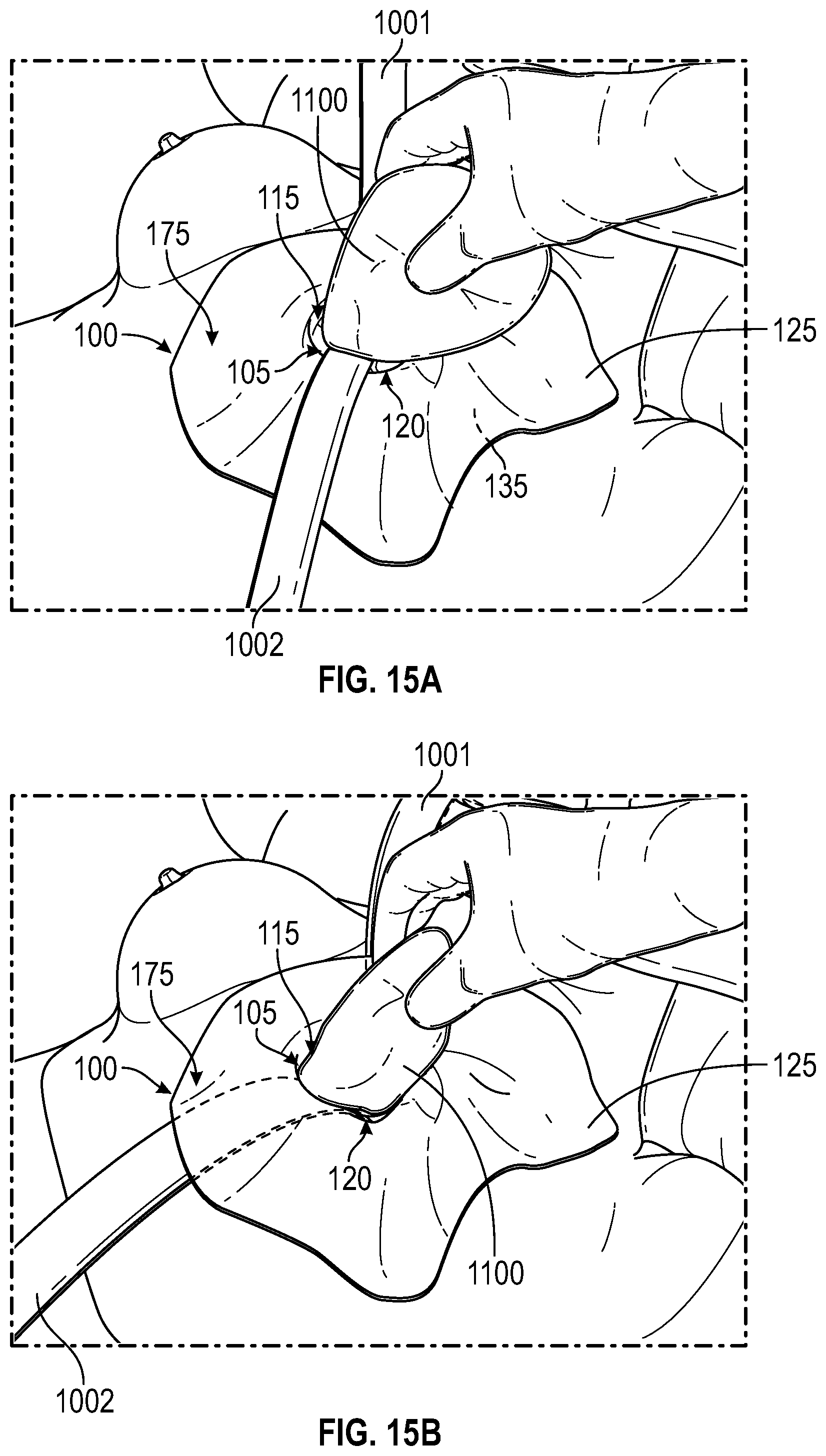 Patent US12137938 Figure 10 – Biofilm protection implant shield