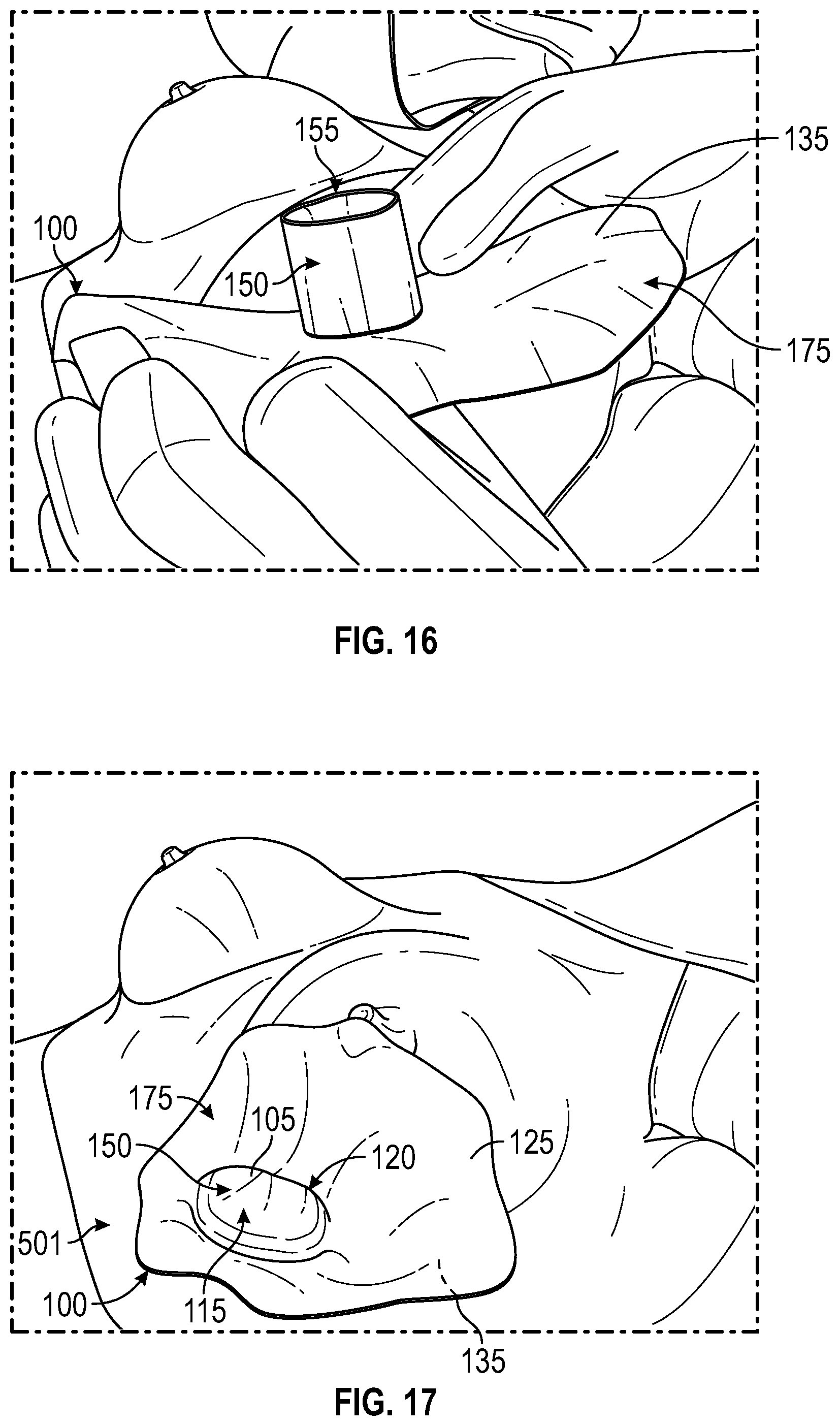 Patent US12137938 Figure 11 – Biofilm protection implant shield