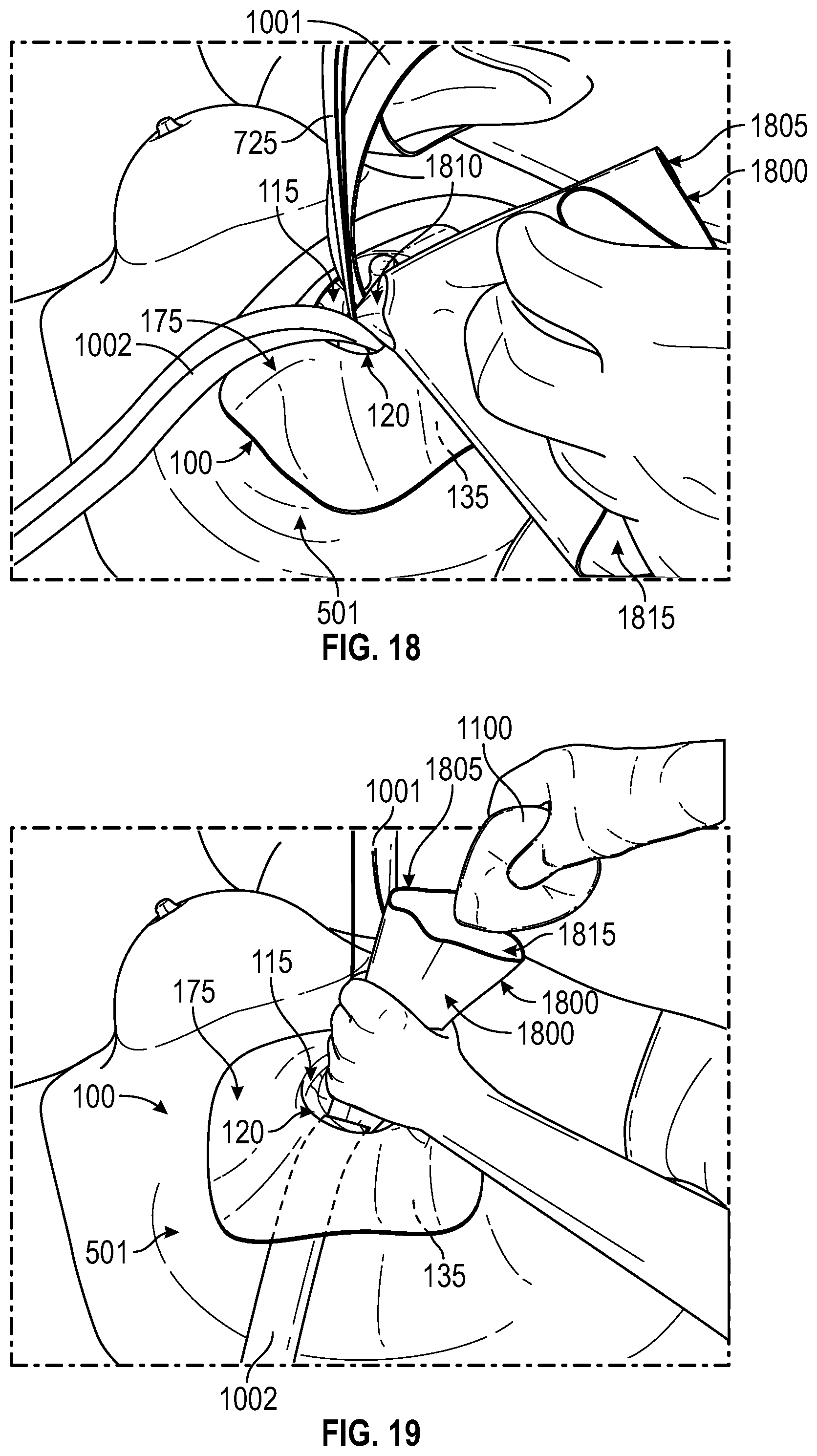 Patent US12137938 Figure 12 – Biofilm protection implant shield