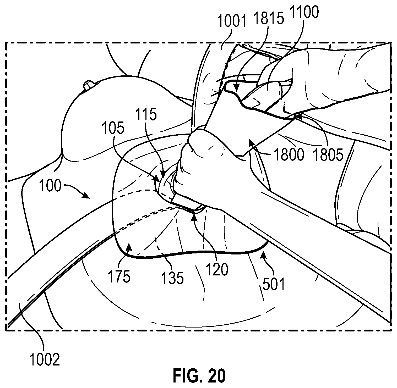 Patent US12137938 Figure 13 – Biofilm protection implant shield