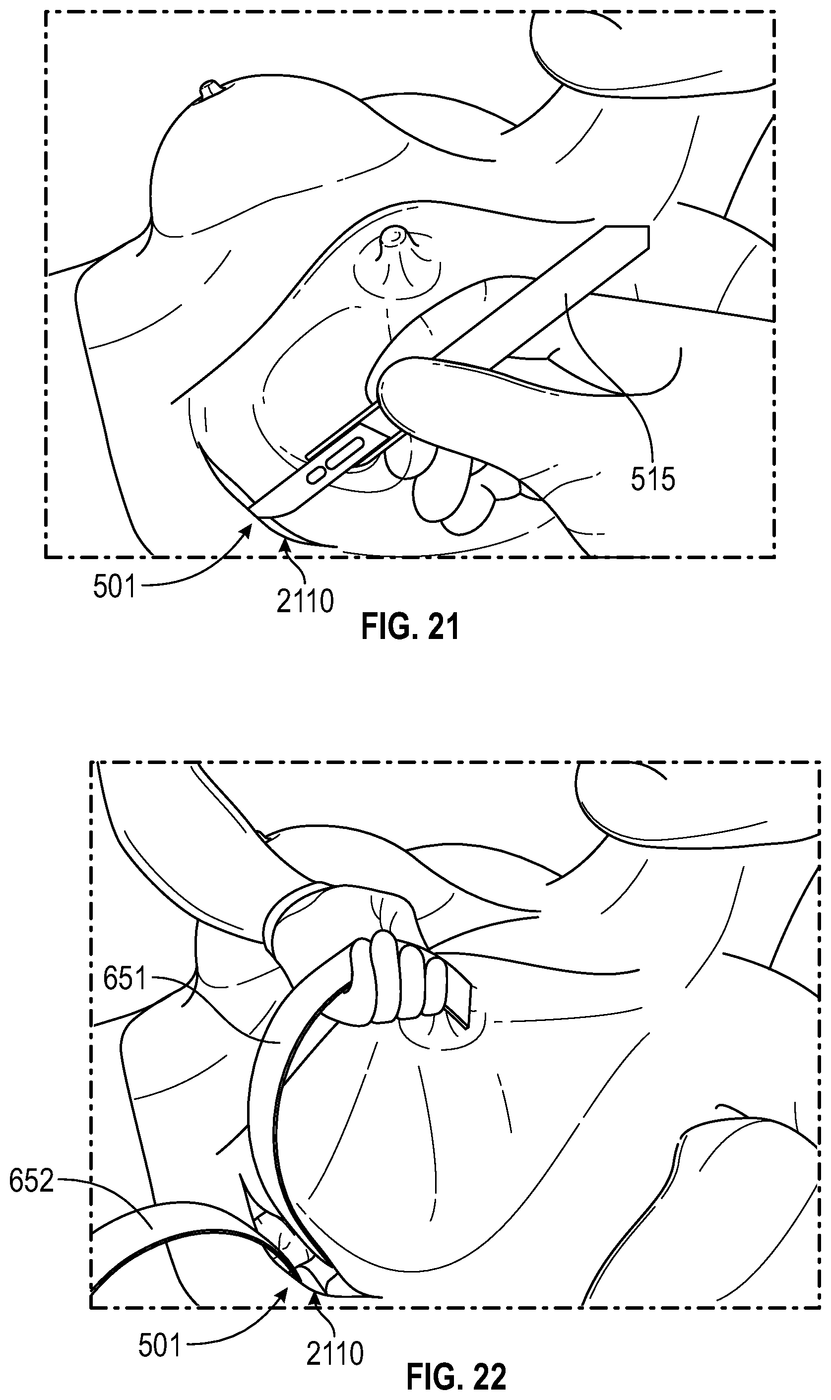 Patent US12137938 Figure 14 – Biofilm protection implant shield