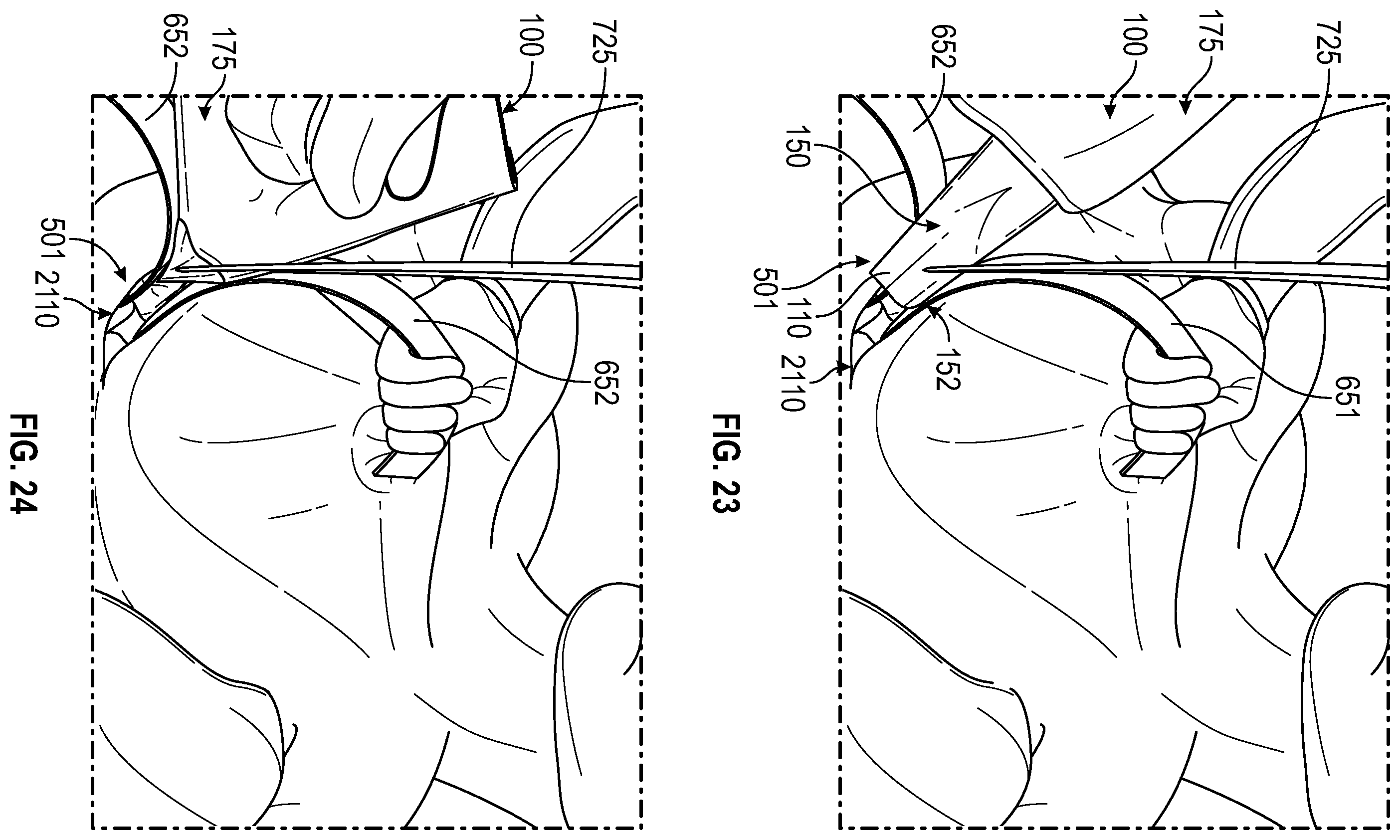 Patent US12137938 Figure 15 – Biofilm protection implant shield