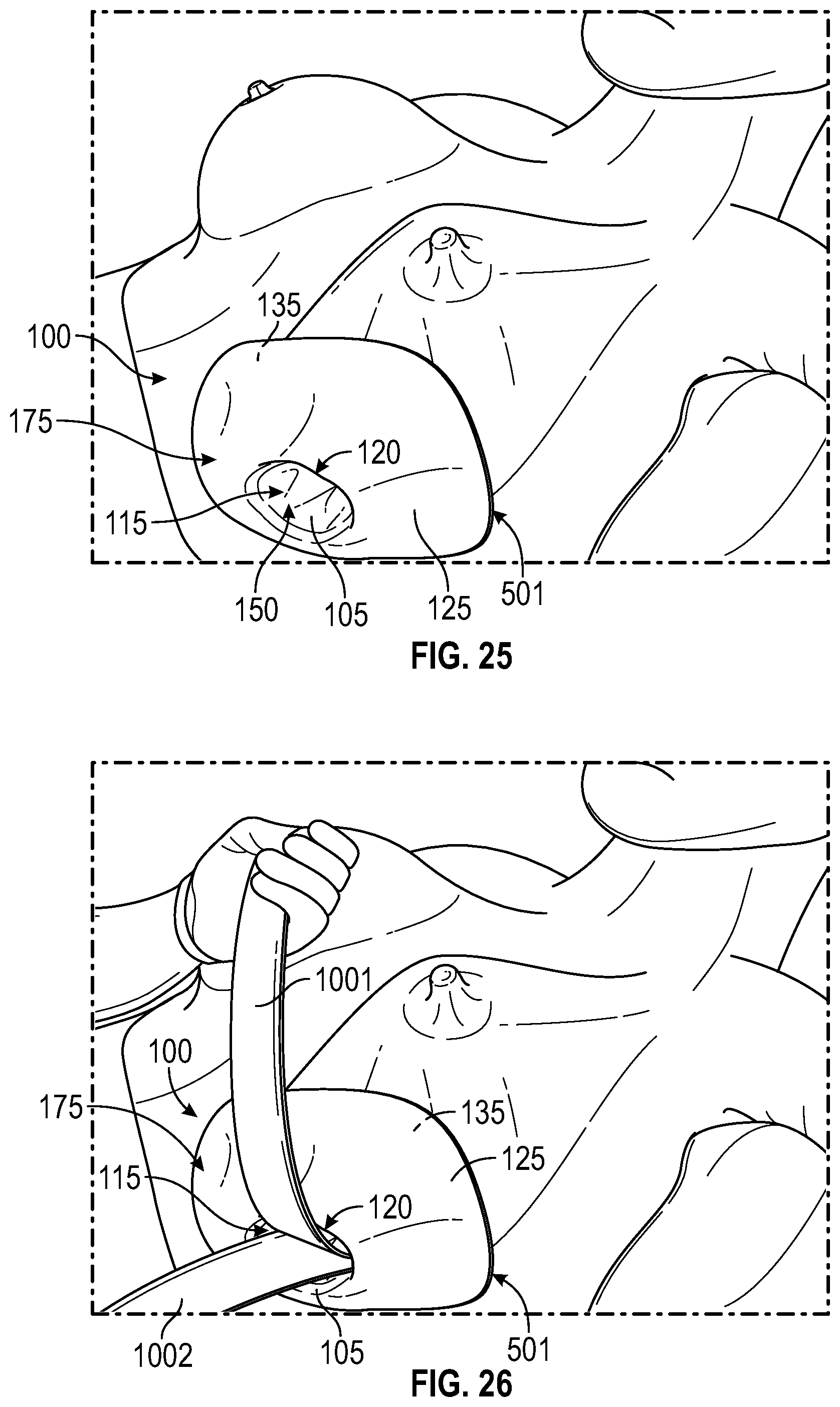 Patent US12137938 Figure 16 – Biofilm protection implant shield