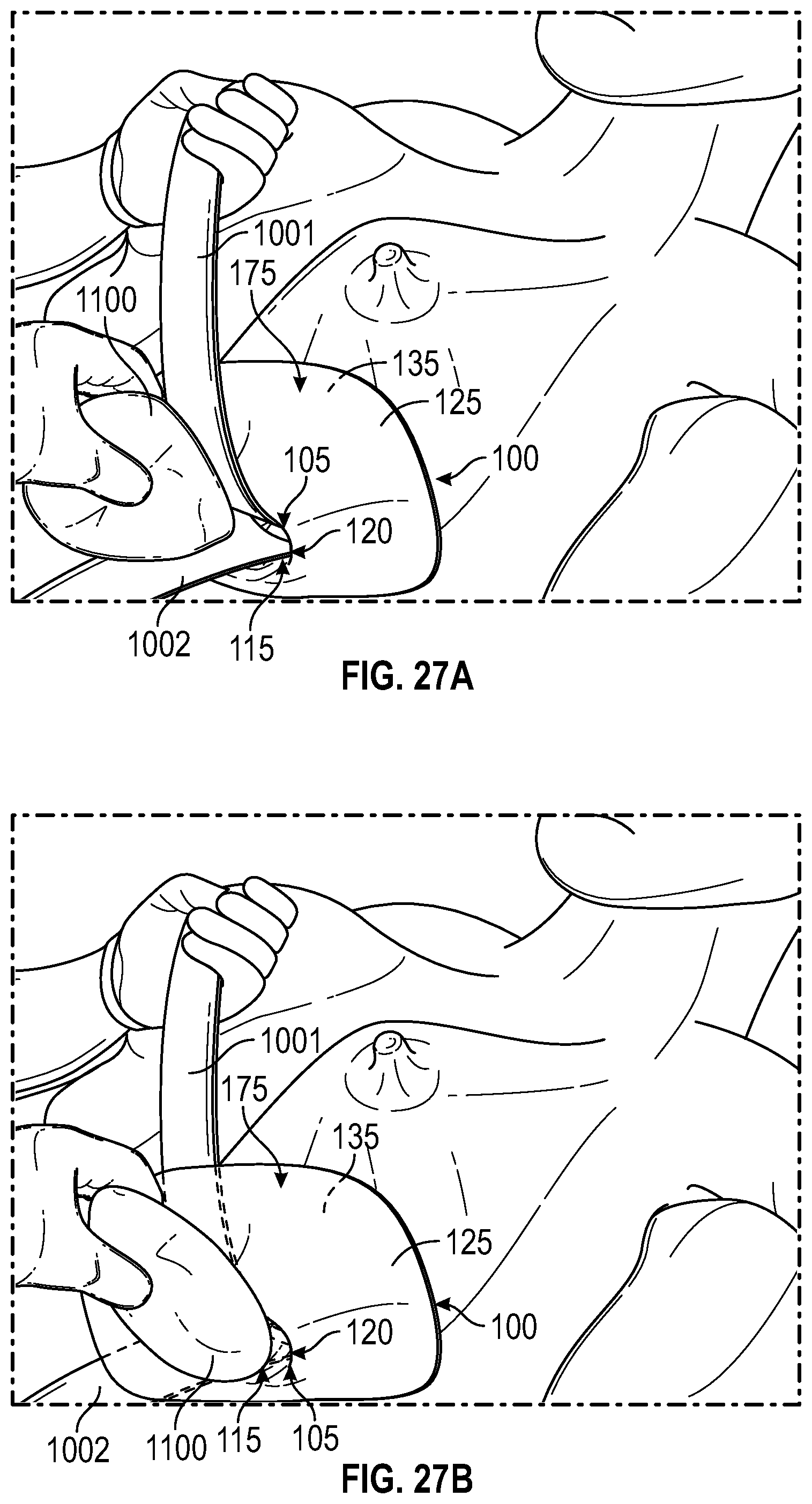 Patent US12137938 Figure 17 – Biofilm protection implant shield