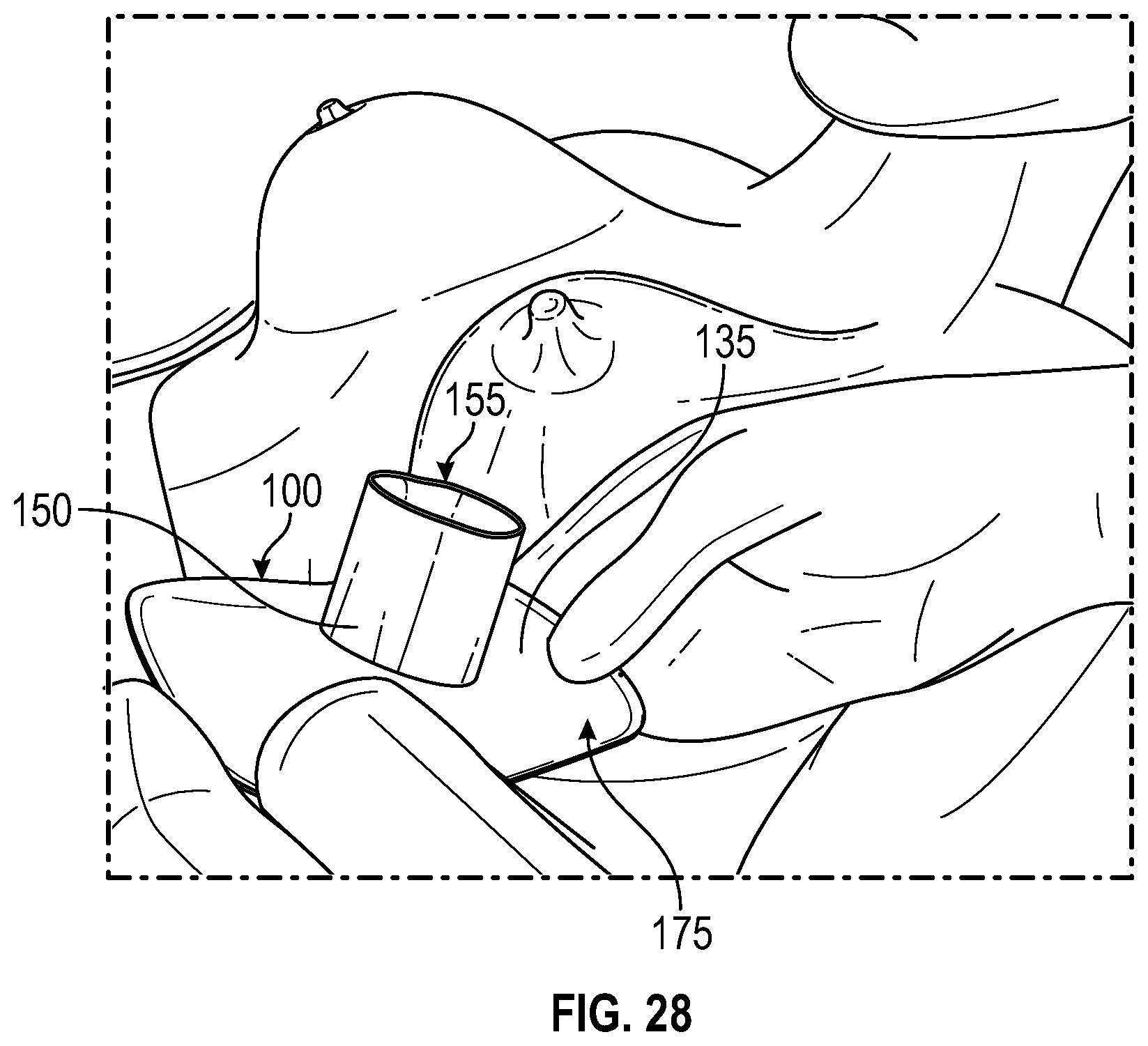 Patent US12137938 Figure 18 – Biofilm protection implant shield