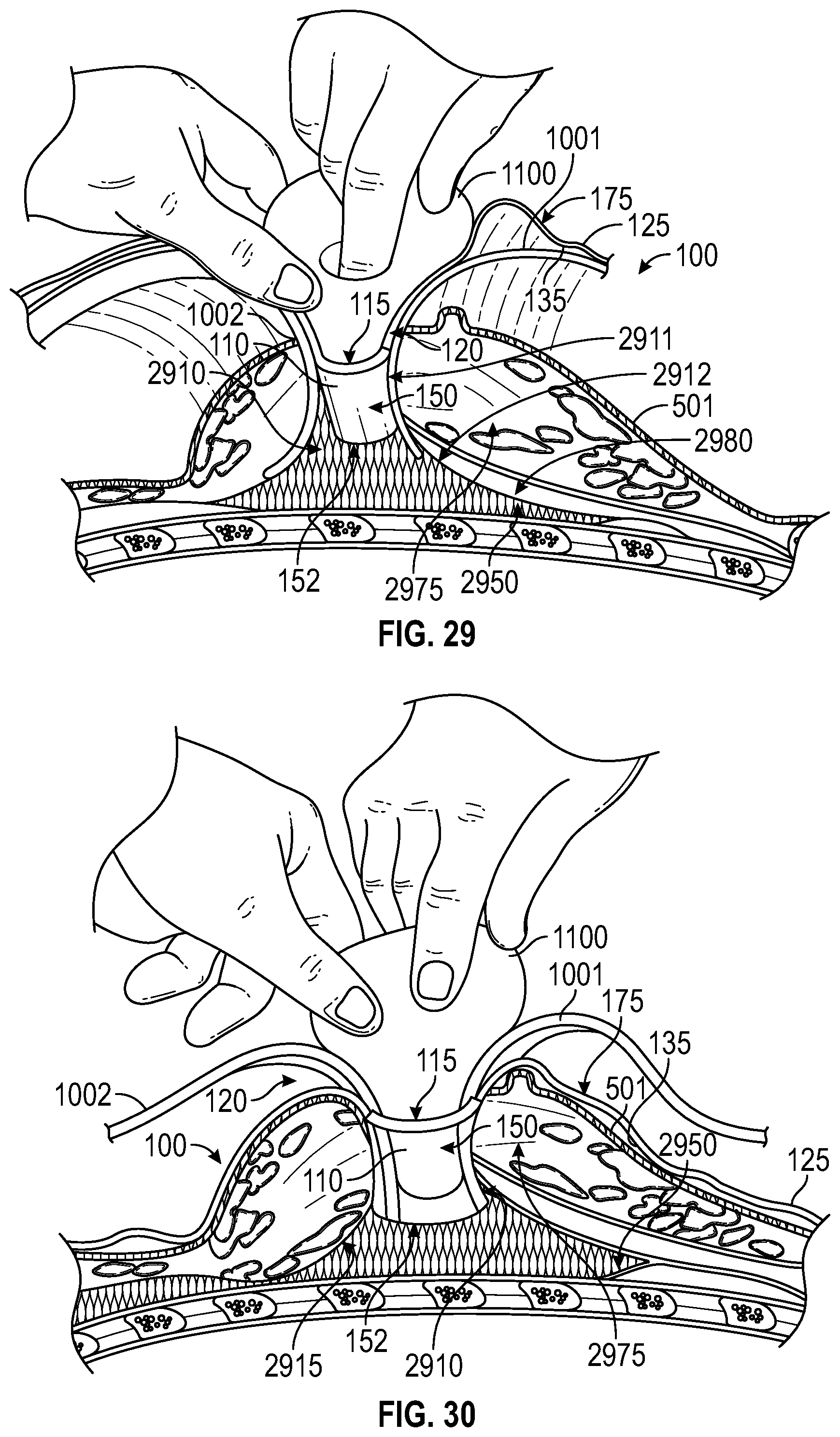 Patent US12137938 Figure 19 – Biofilm protection implant shield