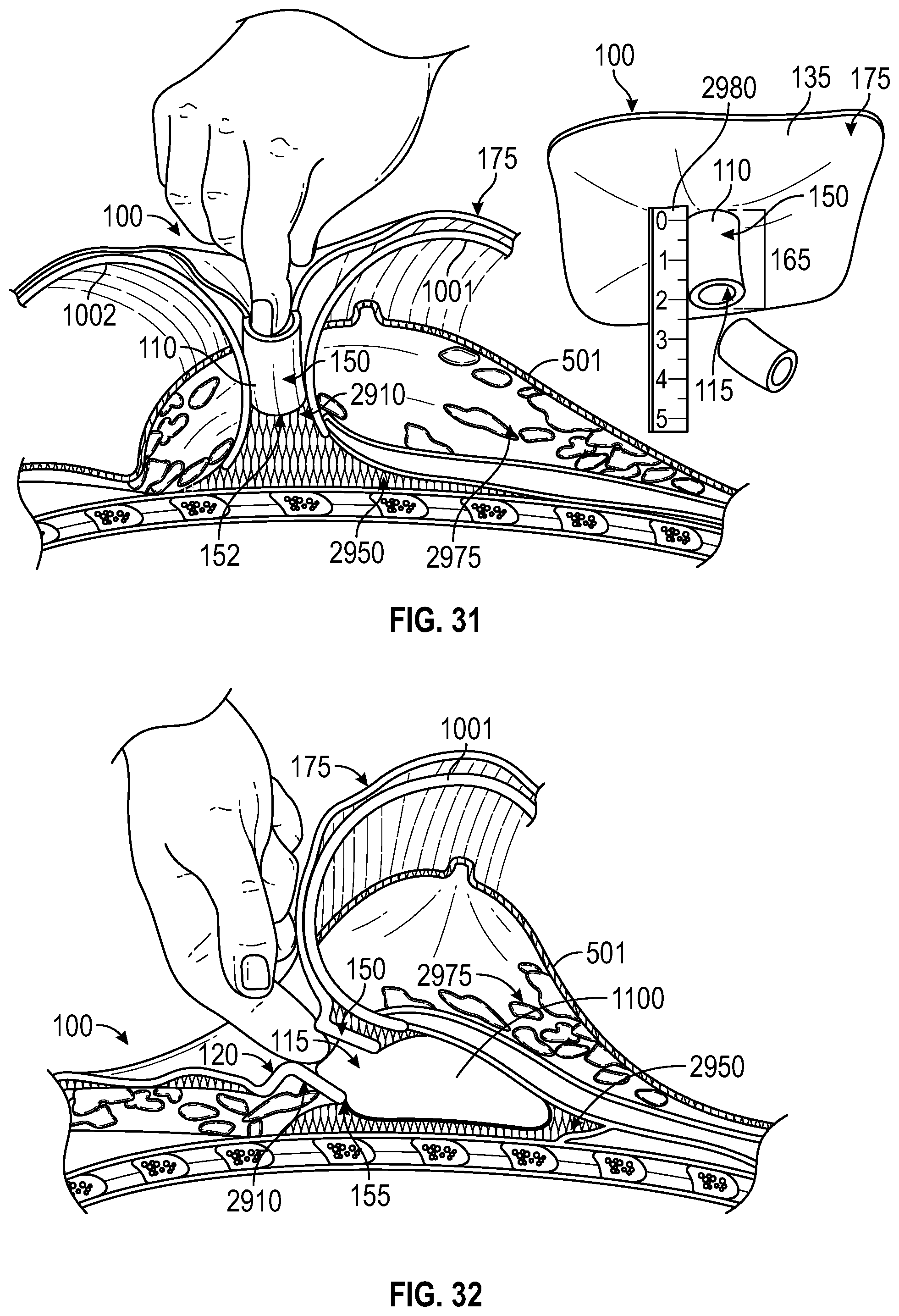 Patent US12137938 Figure 20 – Biofilm protection implant shield